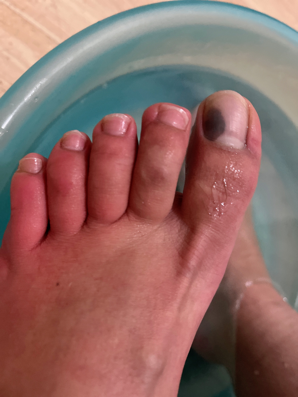 突然脚趾头黑了一块 有没有哪位姐妹知道这是什么情况?