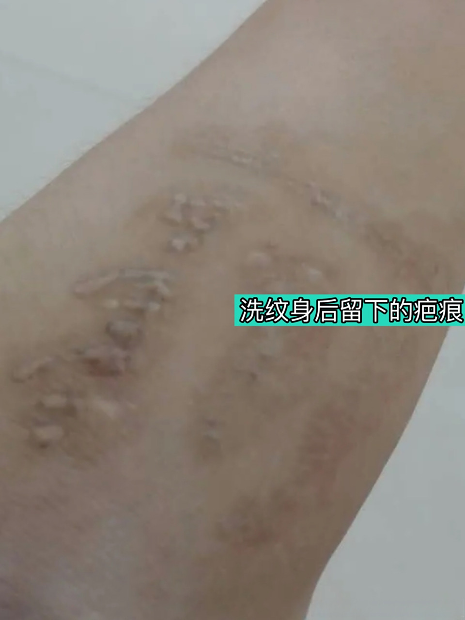 【疤友咨询】洗纹身后留下了增生疤痕,特别难看怎么办?