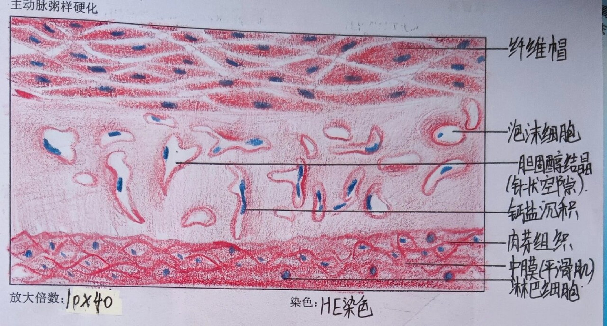 7215病理学红蓝铅笔第二弹 16615小叶性肺炎 95实变病灶内