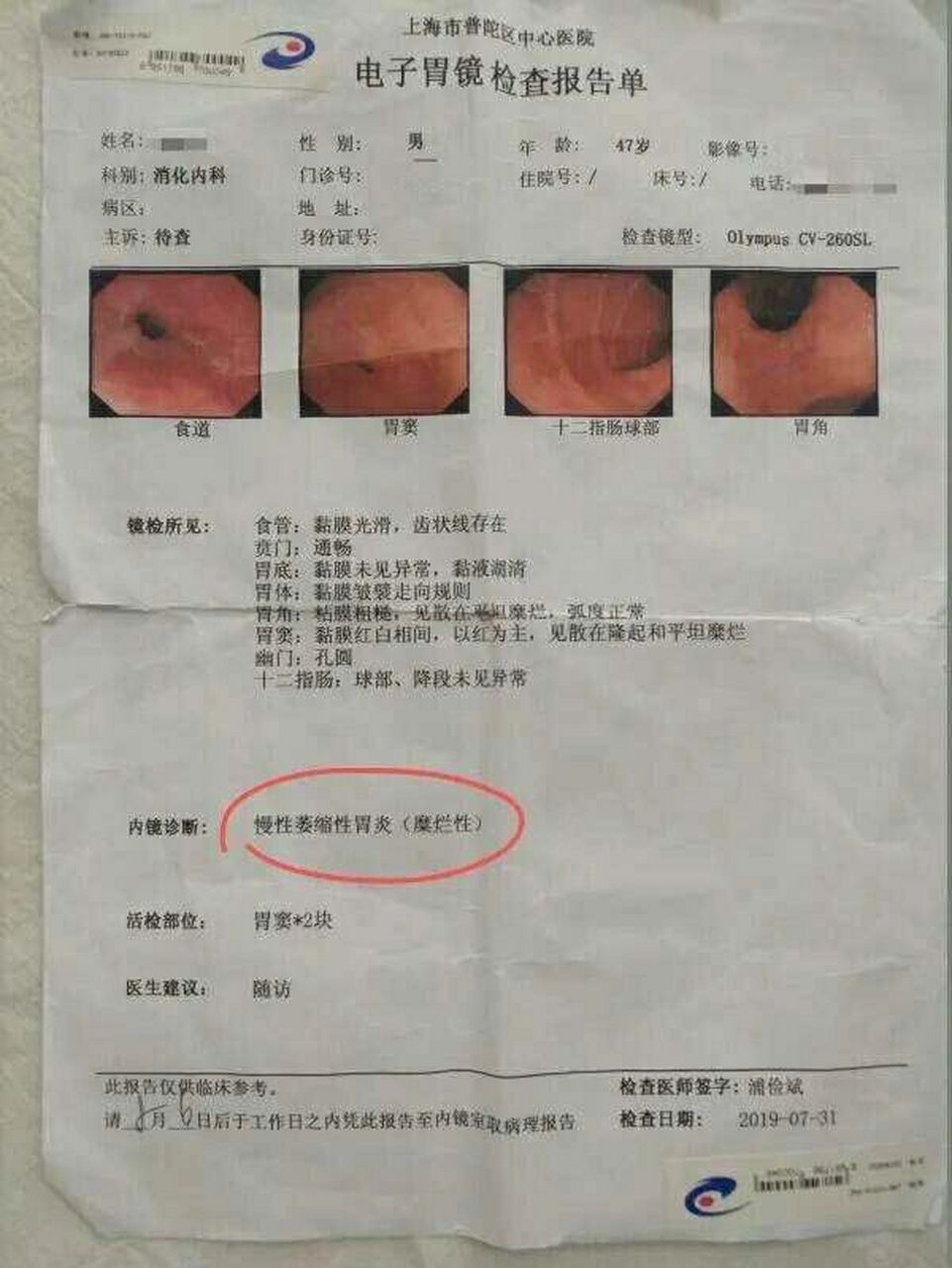 现病史:患者半年前与儿媳吵架后出现胃院部不适,以胀为主,饭后隐痛