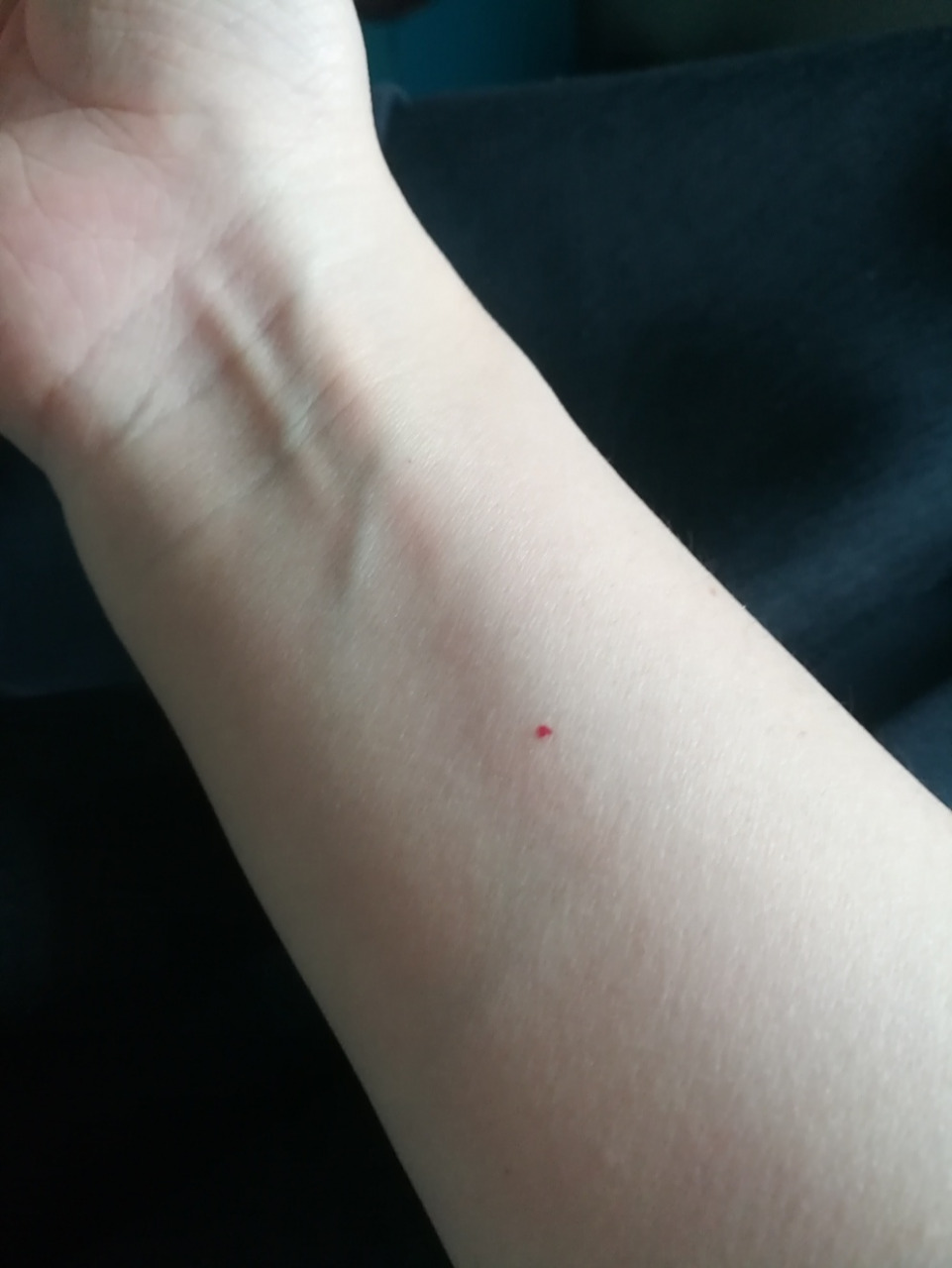 胳膊上小红点:樱桃状血管瘤 2021.05.15看完大家的评论后总结下: 1.