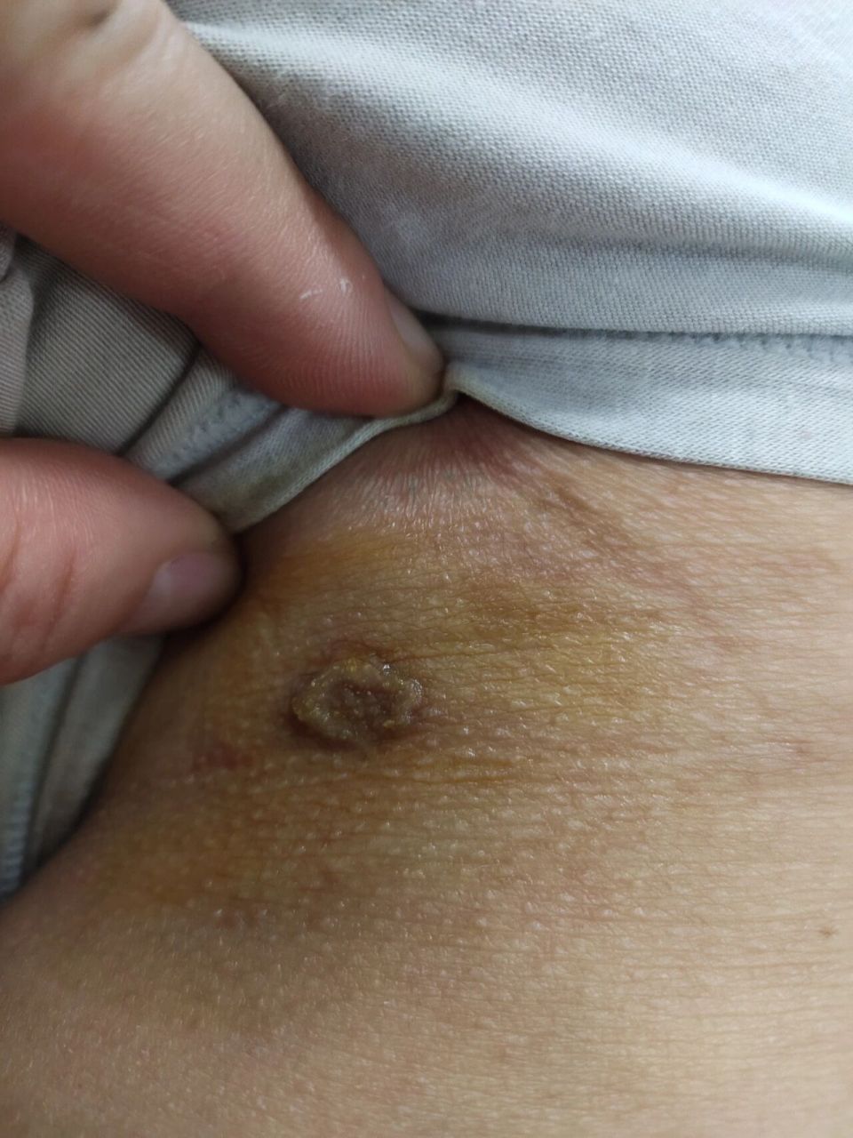 环状肉芽肿 环状肉芽肿是一种少见的良性炎症性皮肤病.