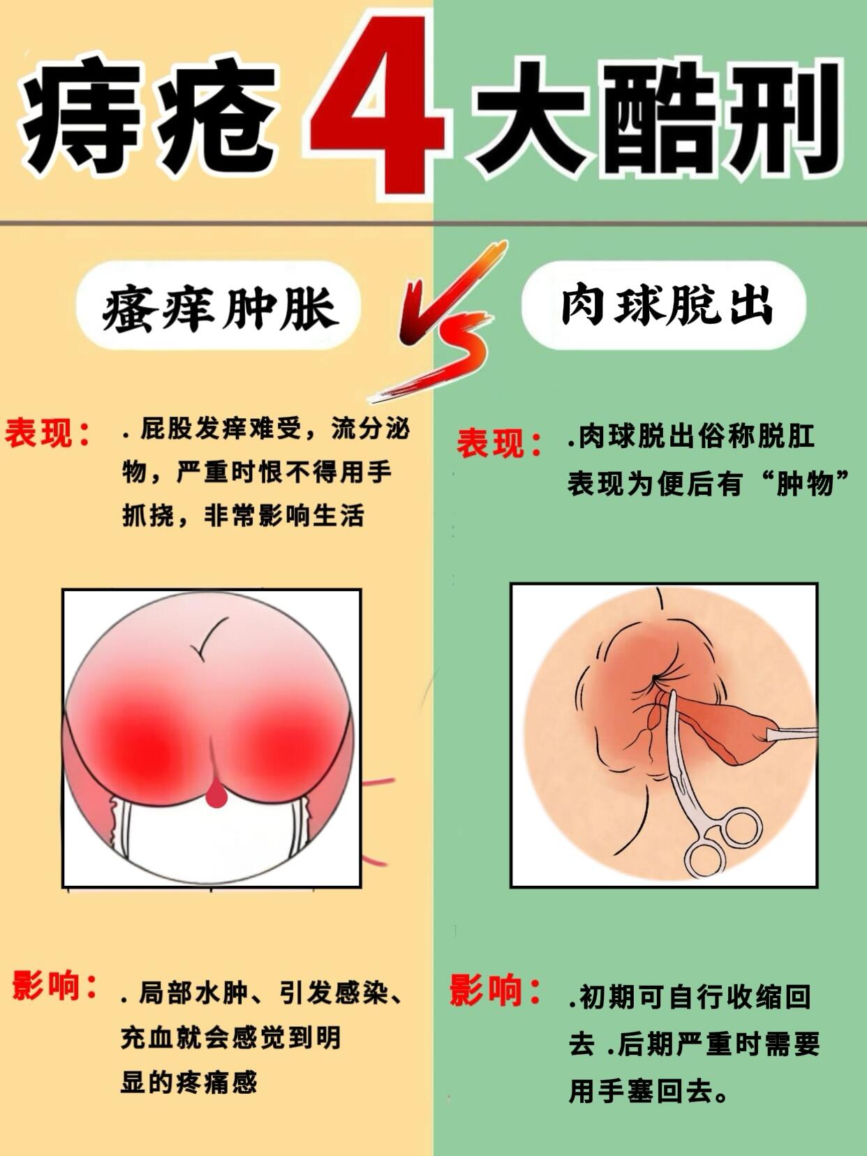 姐妹们有痔疮的痛谁能懂啊,堪比酷刑呀!