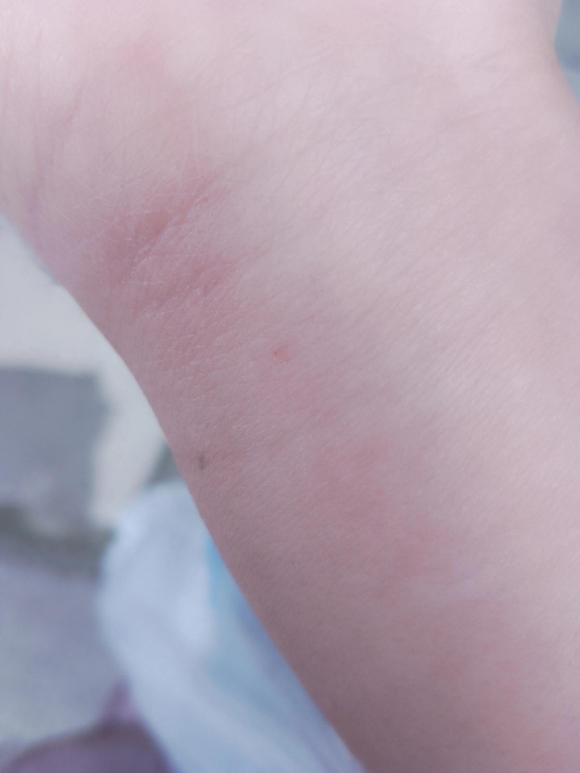 今天刚输完液,当时也忘记问是不是过敏,两年前也是头孢皮试过敏所以