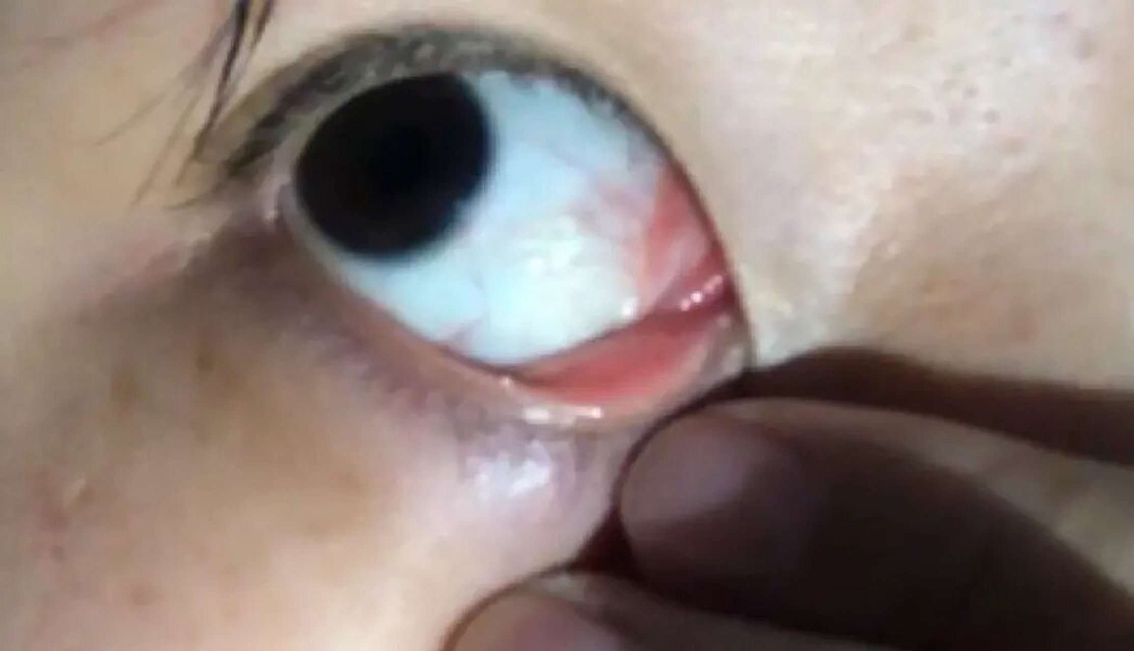 白眼球里莫名其妙长了个水泡 有没有类似的网友 白