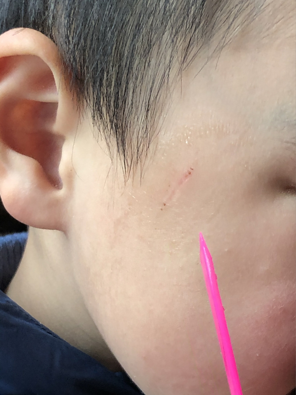 被邻居小孩指甲抓破了,今天一周了,结痂脱落后凹陷了,这种会留疤痕