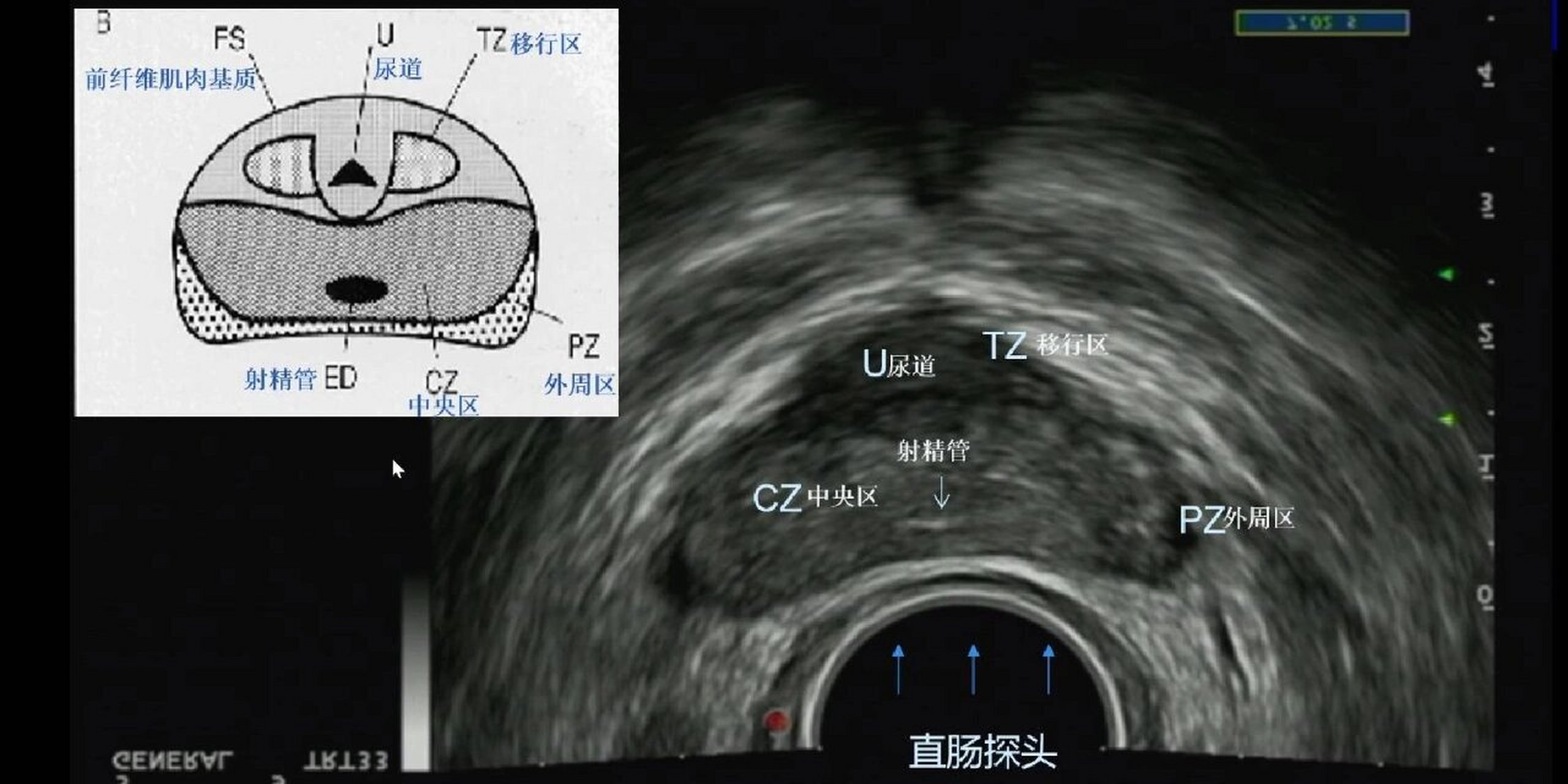 前列腺正常彩超图图片