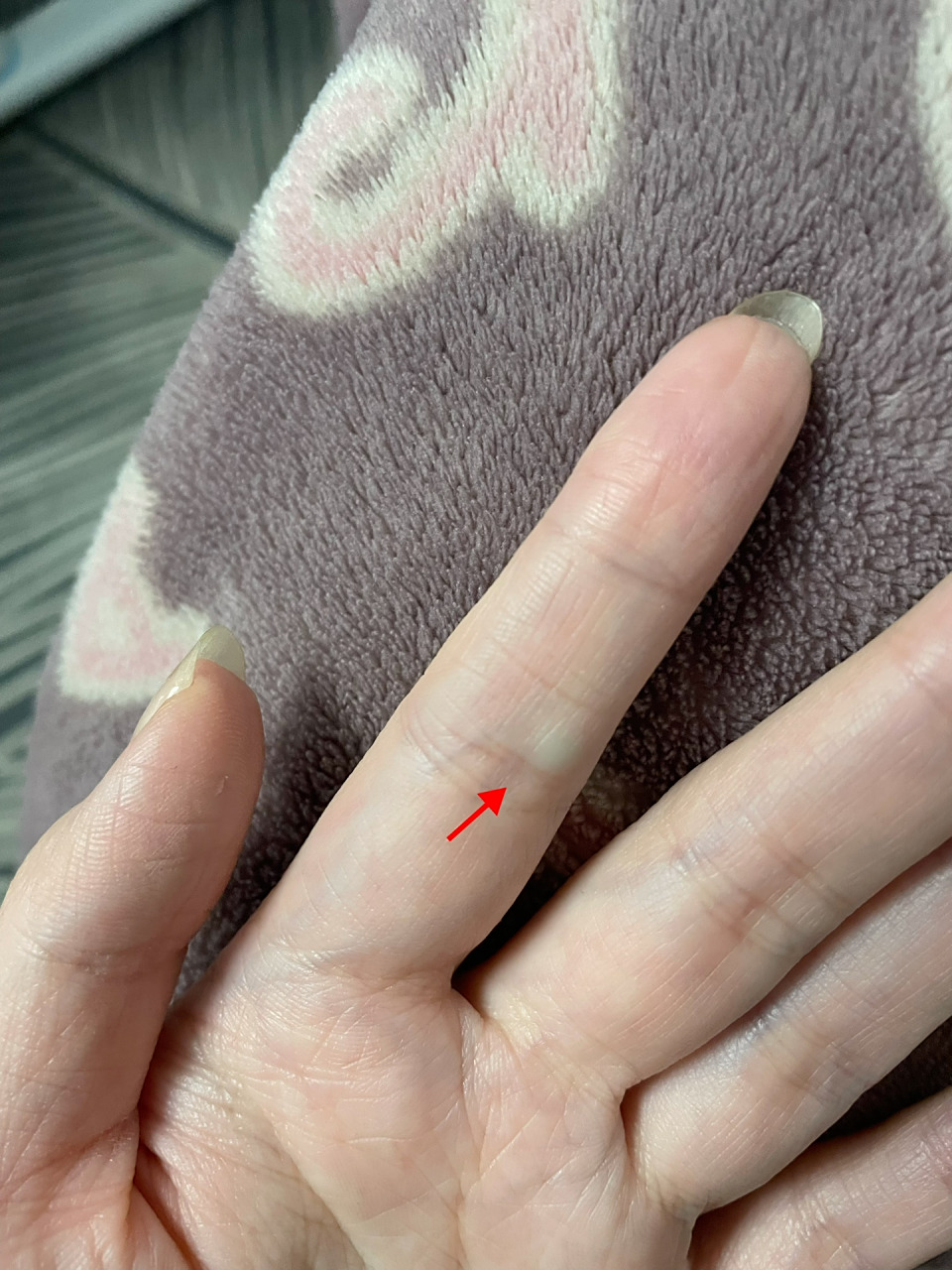 手指长了一个包,怎么办?