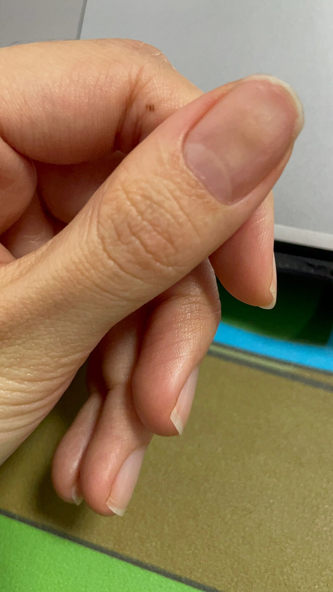 手指甲床根部脱离 家人们,有人知道这个手指是什么情况吗?