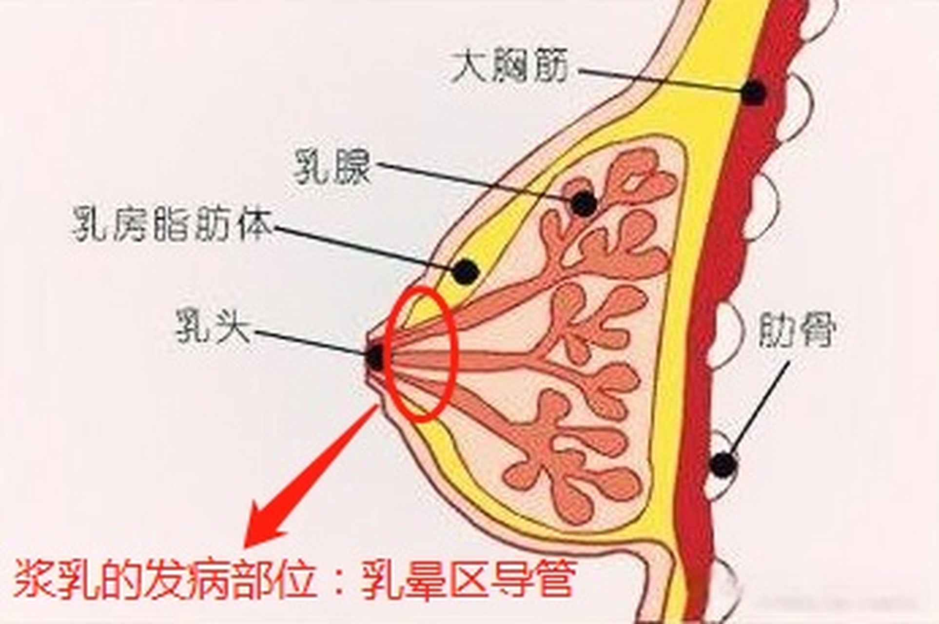 浆细胞乳腺炎 症状图片
