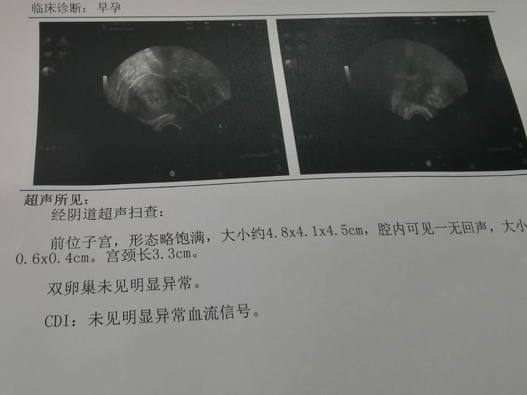 孕35天做了阴超,发现了孕囊,排除宫外孕 停经6天,孕35天,晚上下腹部
