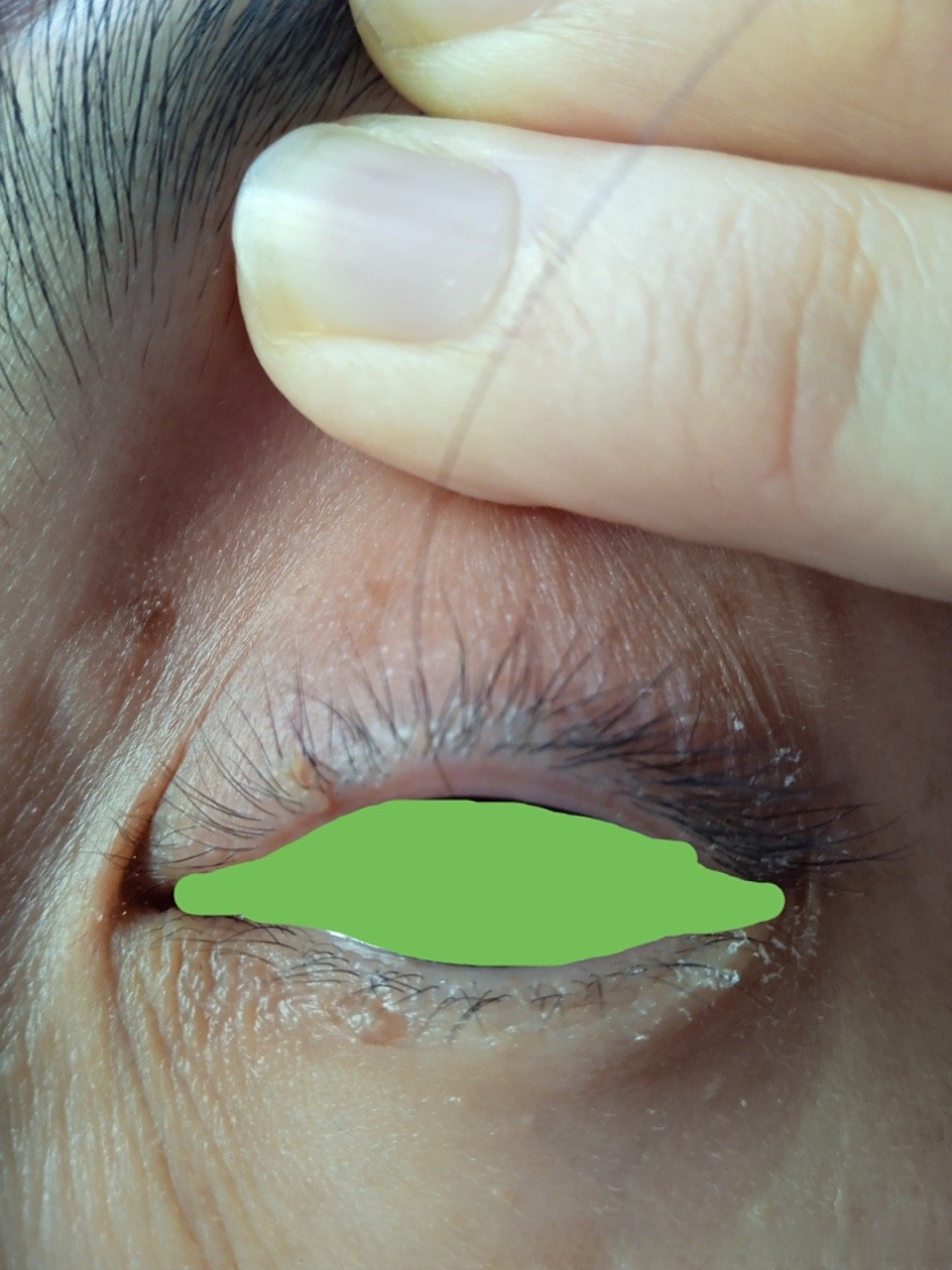 微博健康公开课# 眼周的是丝状疣