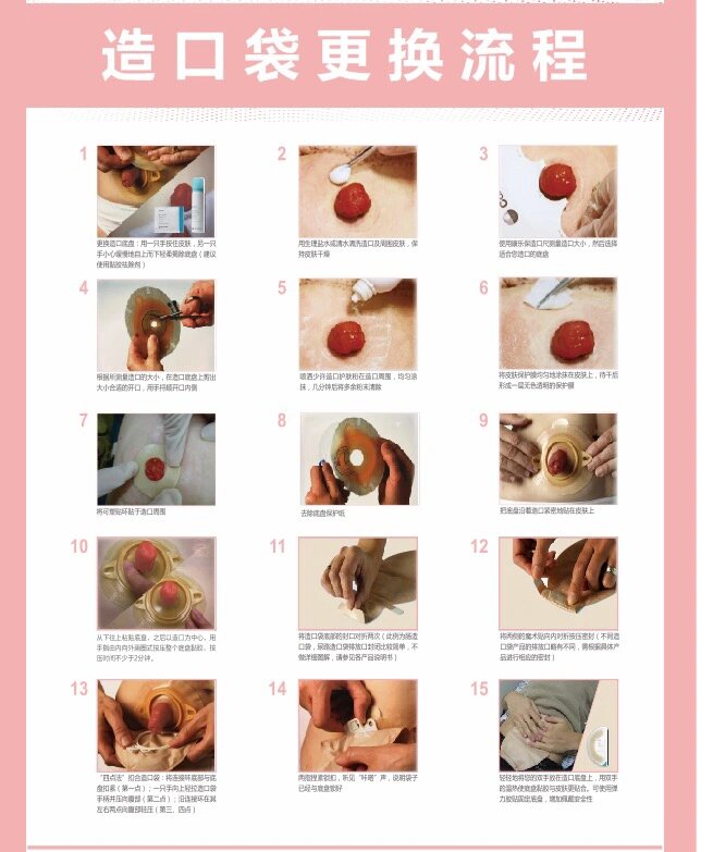 造口袋更换流程图解图片