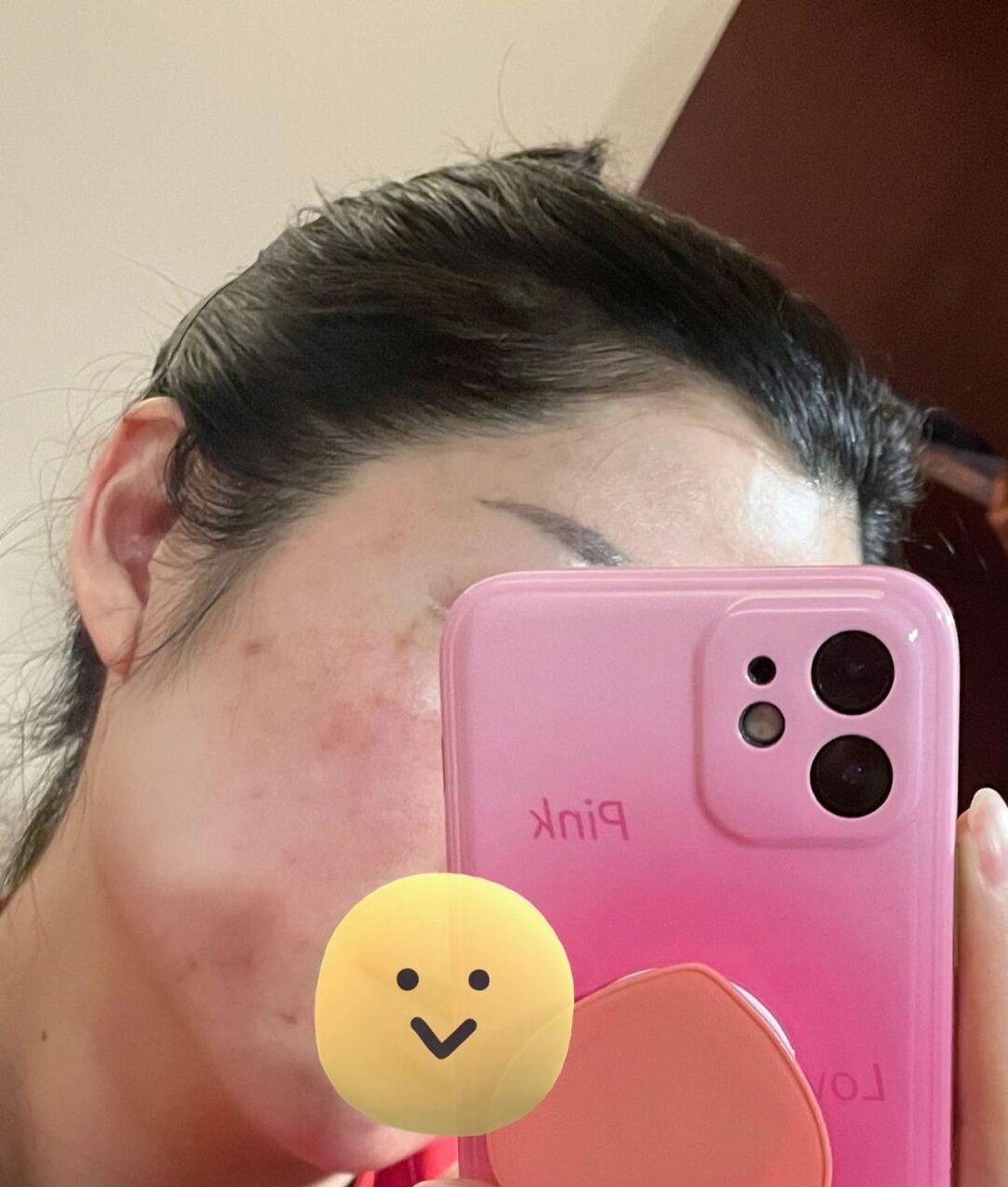 三甲医院第三次刷酸,刷了50%薇诺娜果酸,当天脸超红超烫!