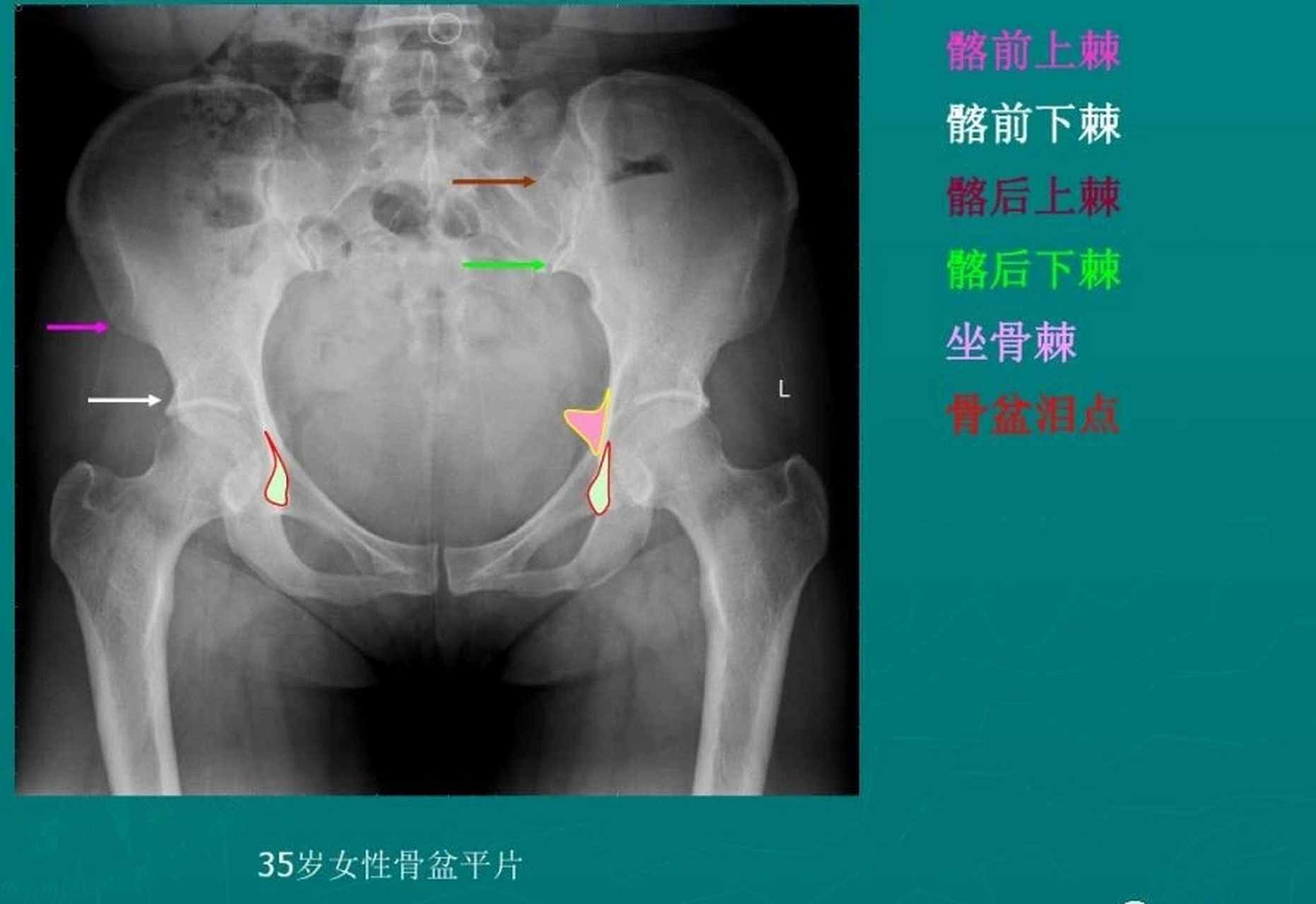 髋骨正常的影像图图片