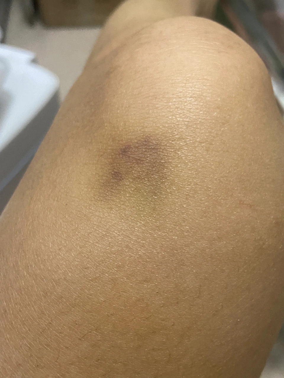 膝盖总是会有莫名其妙的淤青,不记得有撞到,但是隔一段时间就出现