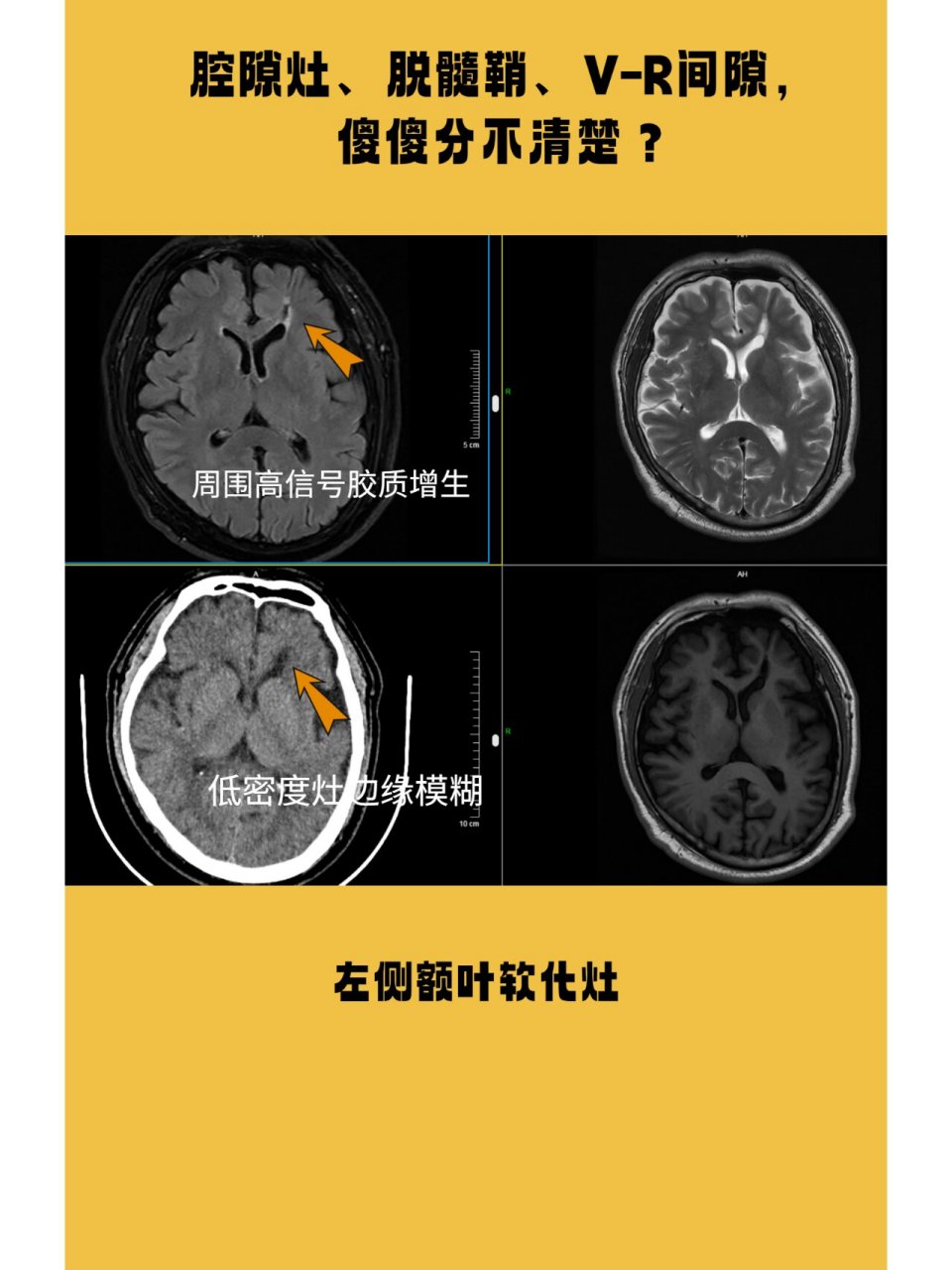 腔隙灶,脱髓鞘,v-r间隙的ct与磁共振鉴别 腔隙灶,脱髓鞘,v-r间隙. 