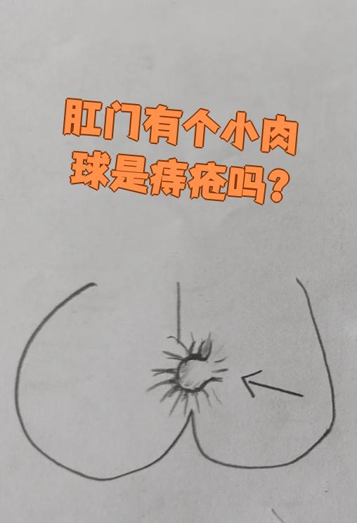 但也可能是其他问题,比如肛门乳头瘤,直肠息肉,肛门湿疣,肛瘘外口
