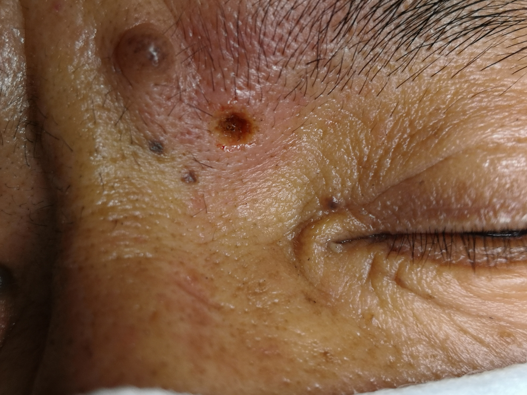 面部色素痣激光治疗去除前后即刻对比图#解决皮肤问题专注皮肤美容