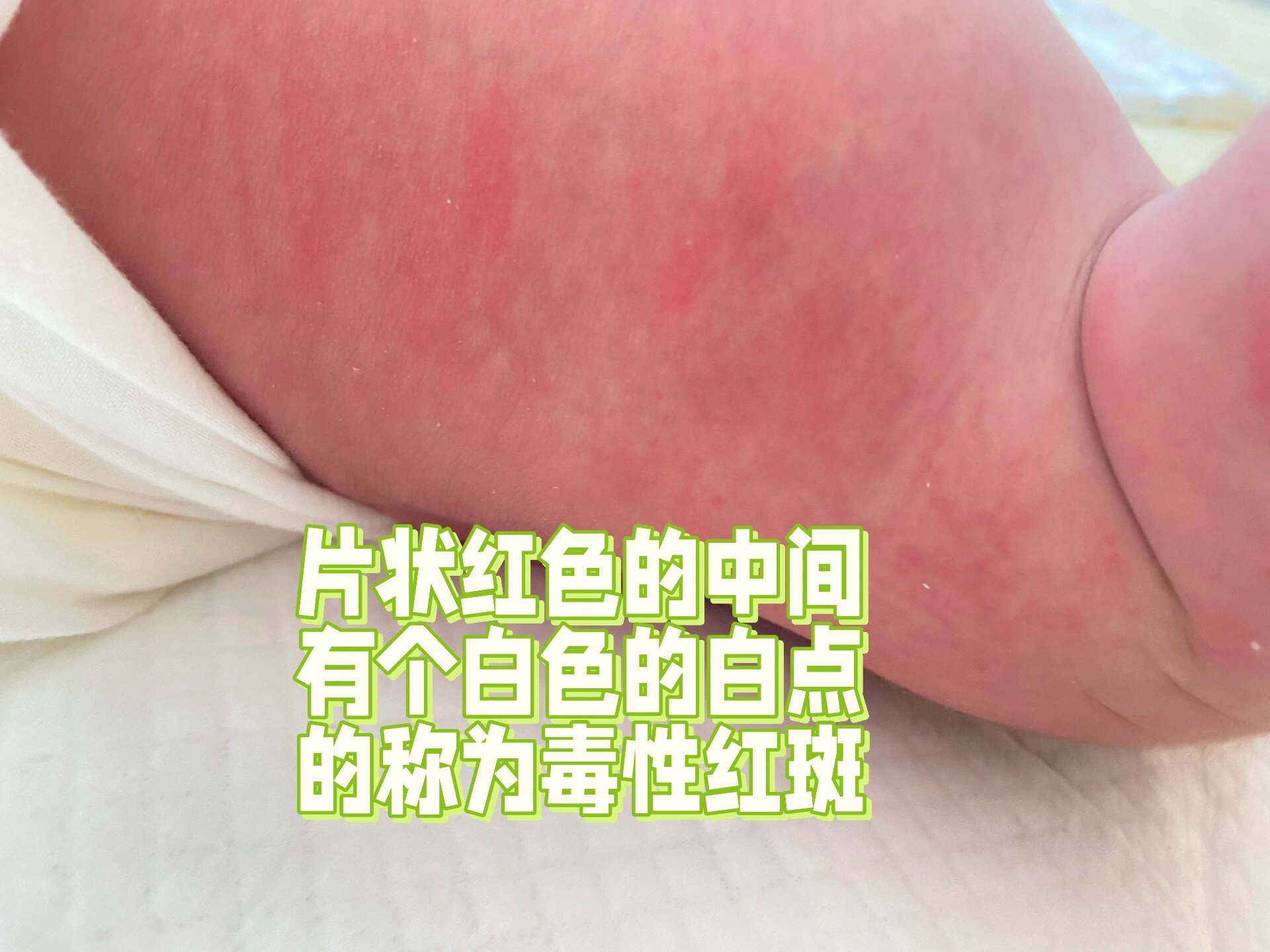 新生儿栗丘疹照片图片