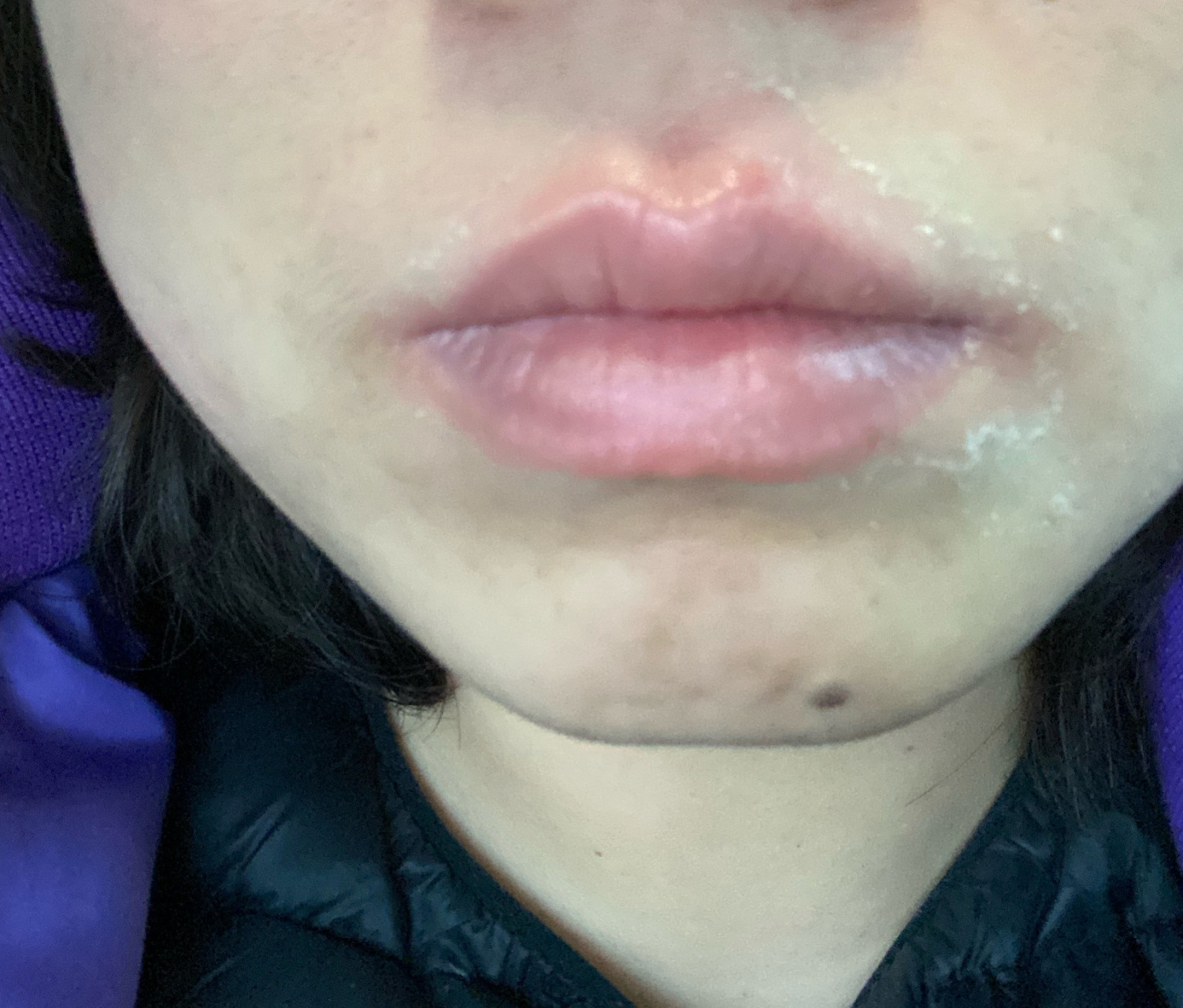 口唇干裂疼痛紧绷脱皮,口周炎 从入秋到现在,这个嘴巴折腾了我好几个