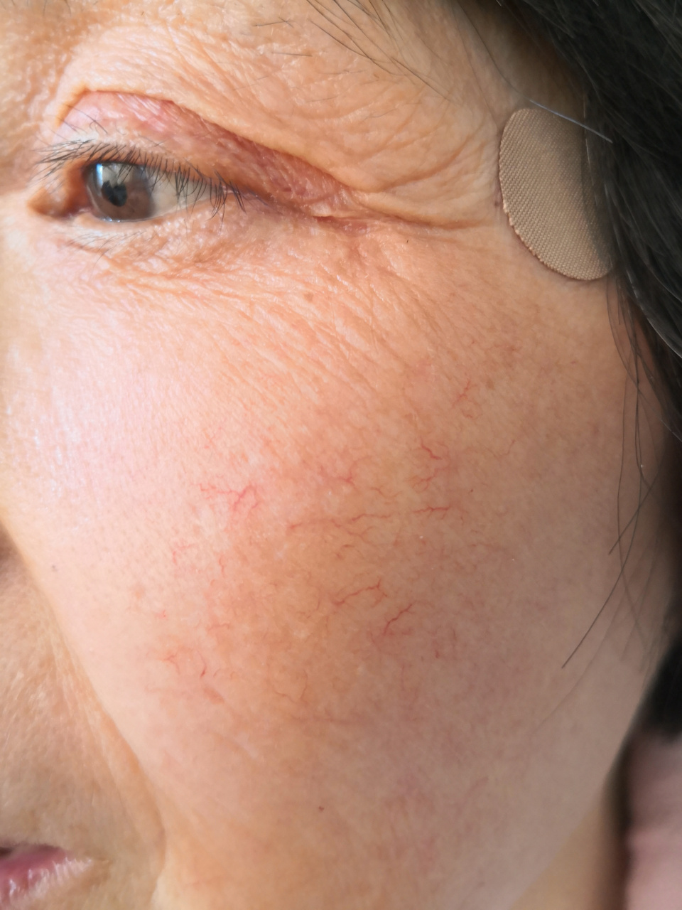 解决皮肤问题专注皮肤美容# 毛细血管扩张症.可以使用激光治疗去除.