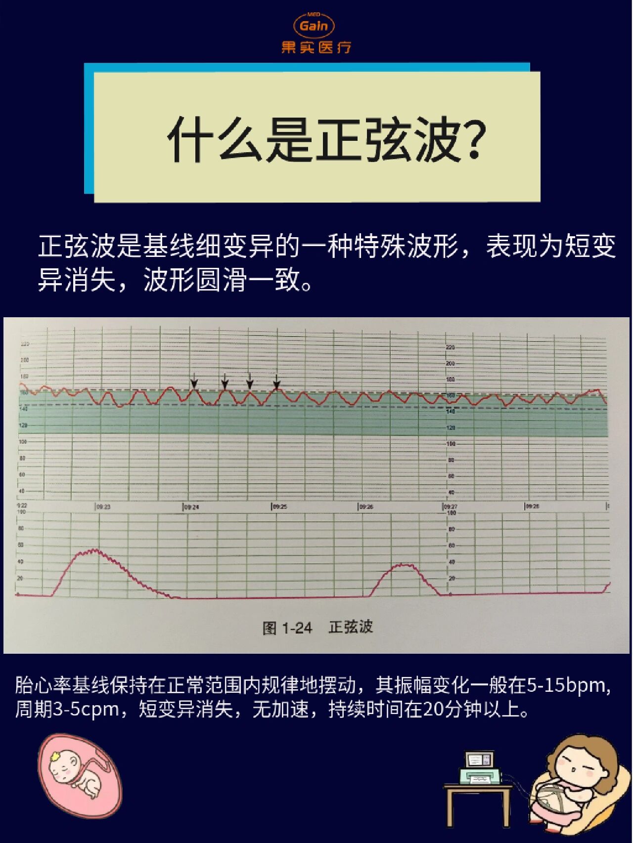 什么是正弦波 正弦波是基线细变异的一种特殊波形,表现为短变异消失