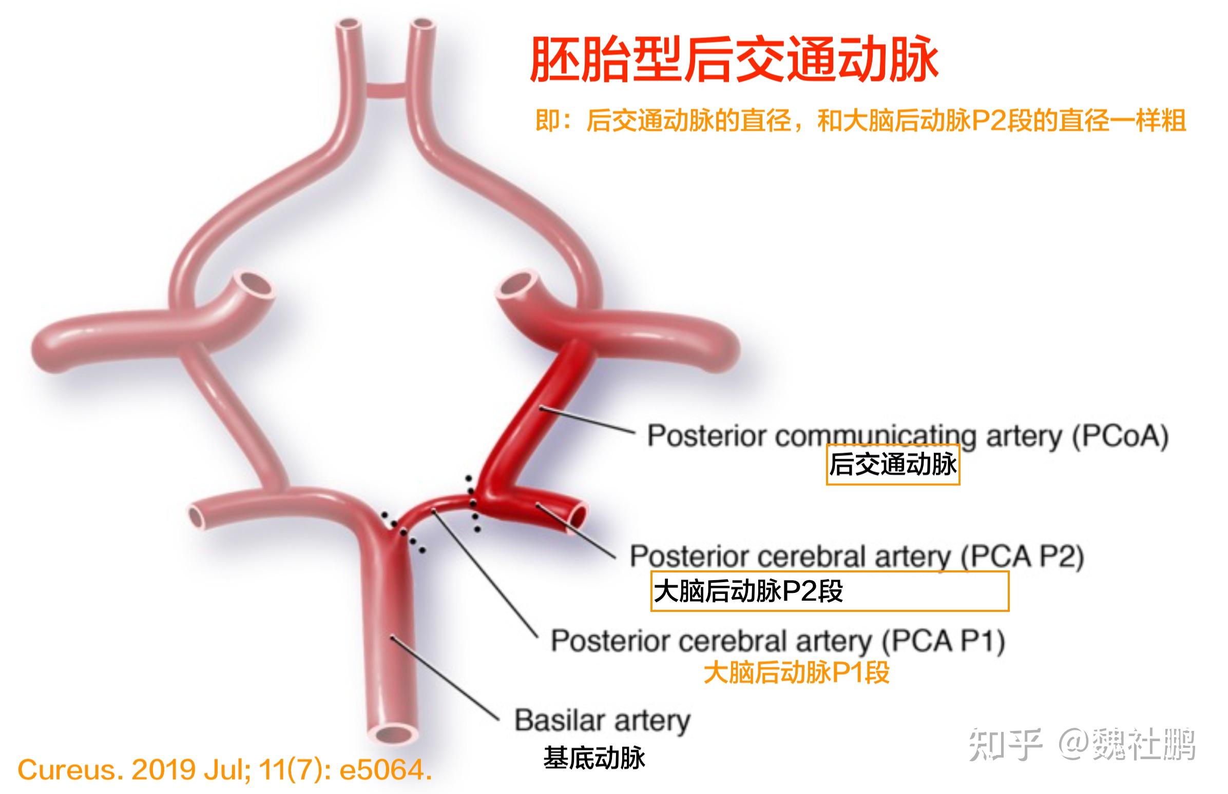 胚胎型大脑后动脉图片图片