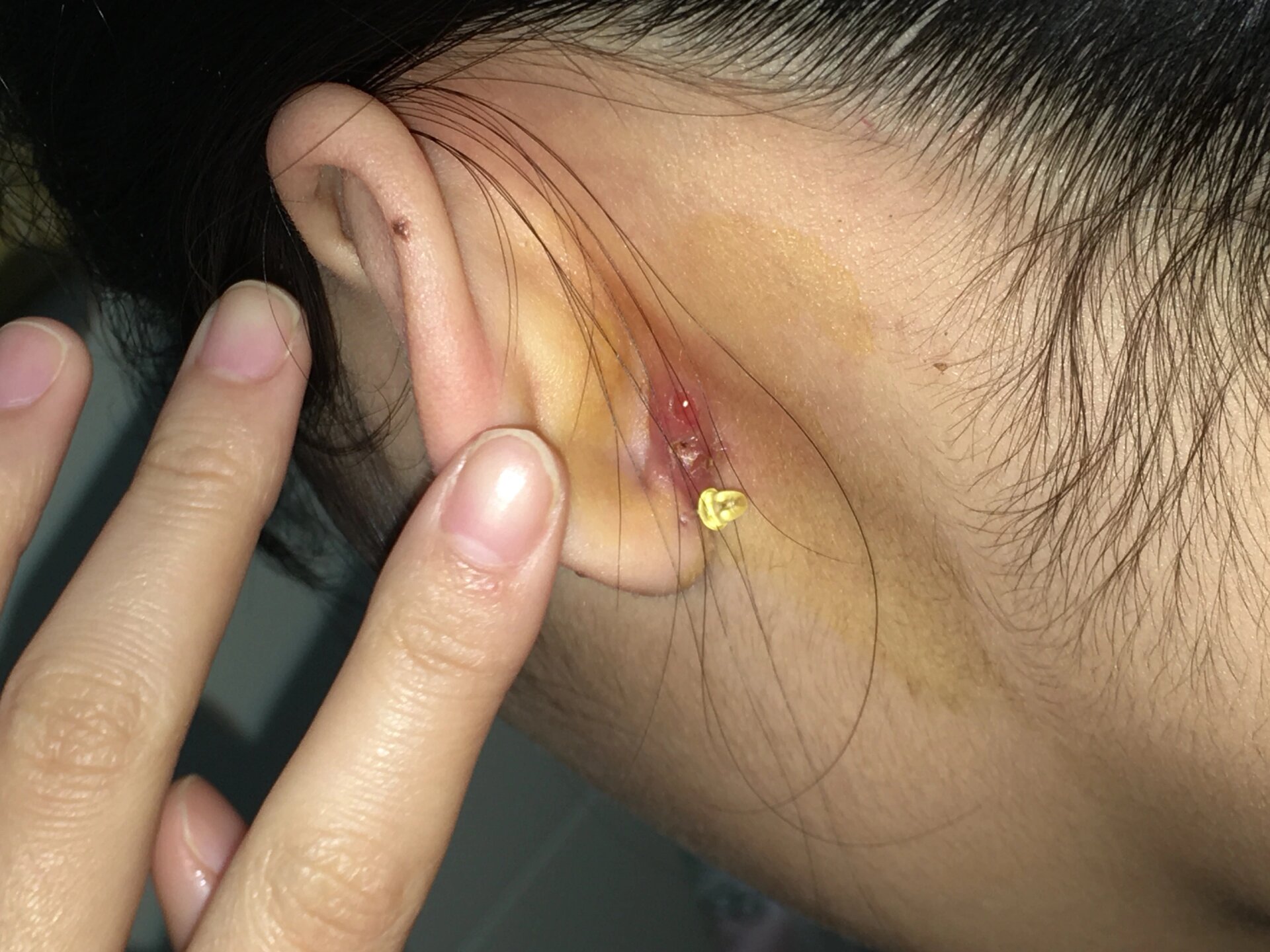 耳后长了脓包 打了耳洞之后长的了,之前也老喜欢扣它,现在碰一下就出