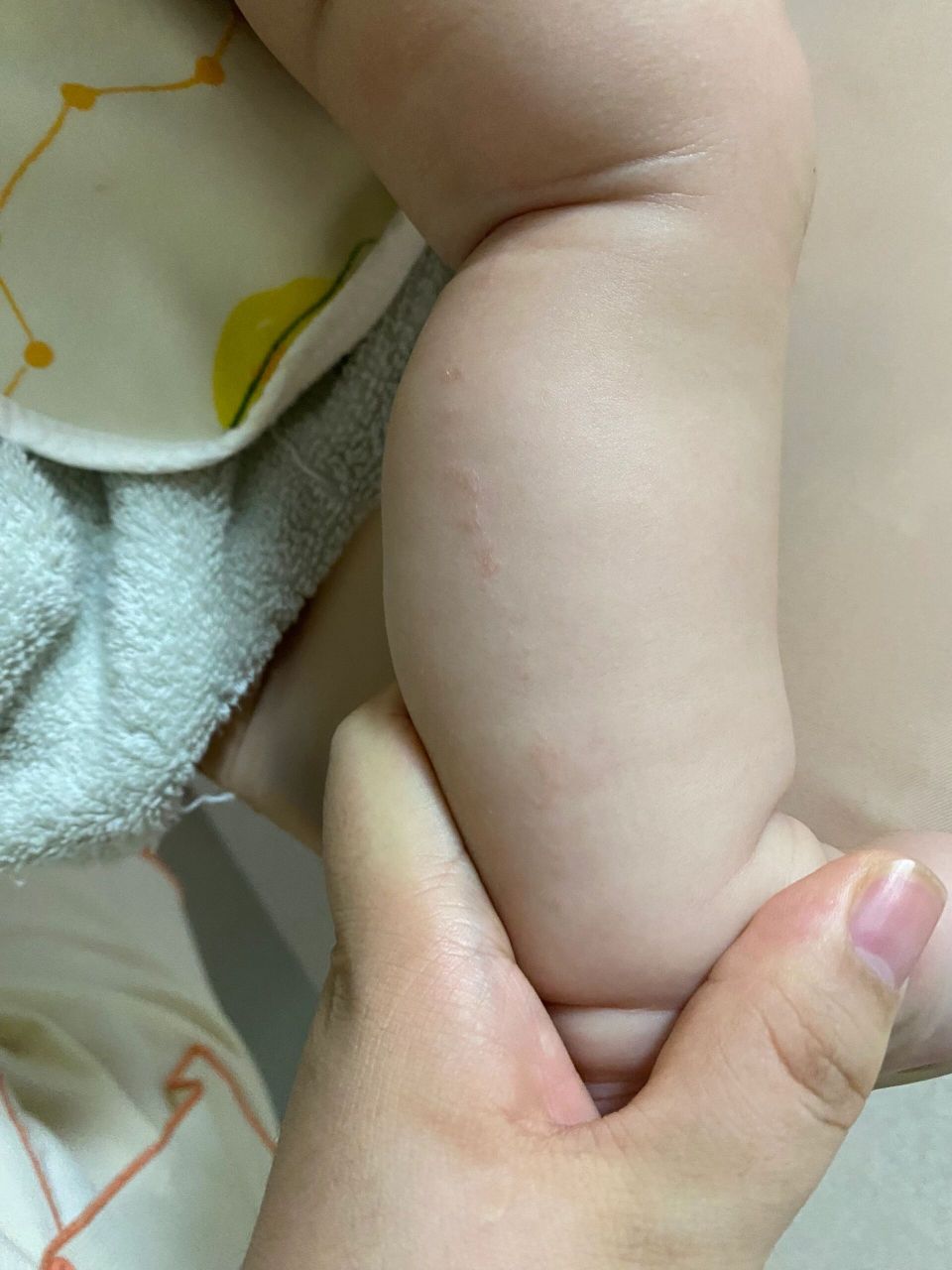 宝宝腿上长了一条线的疙瘩 不知道是什么 有认识的姐妹吗 有两周了 不