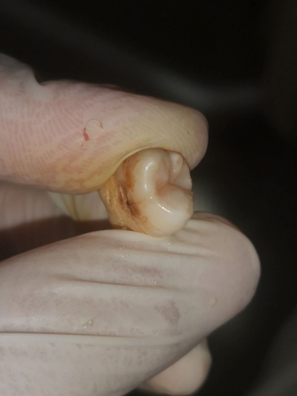 深龋近髓要怎么处理呢?照书上预约去腐,安抚,垫底,充填