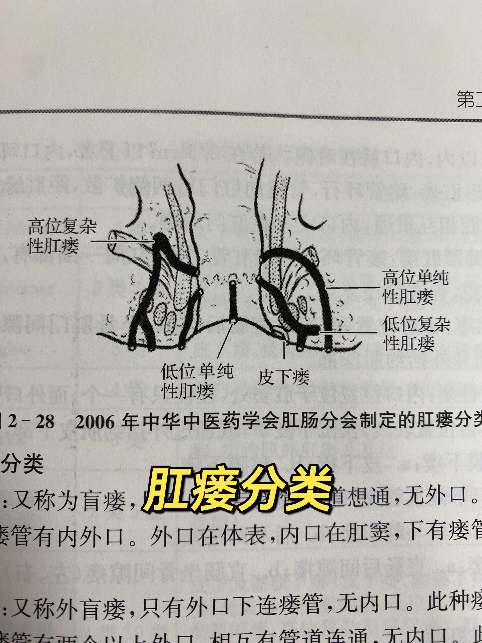 肛瘘高位和低位区分图图片