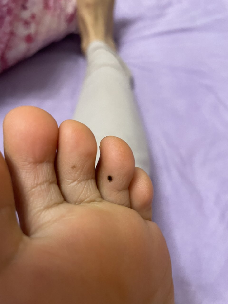 脚上近几年长了一个边缘不规则的黑痣,这个月,旁边脚趾同样的位置隐约