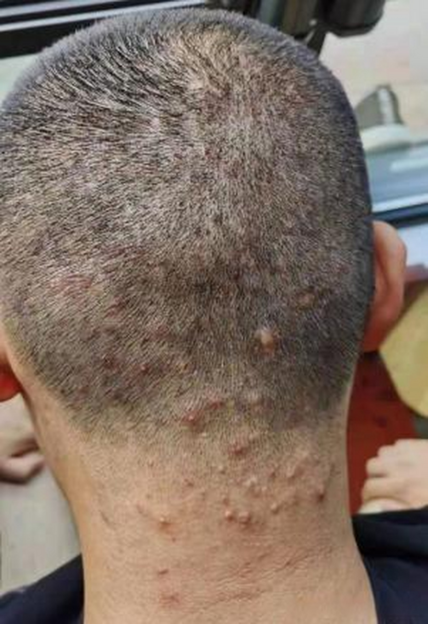 前几天,门诊来个小伙子,说后脑勺上的疙瘩又疼又痒.