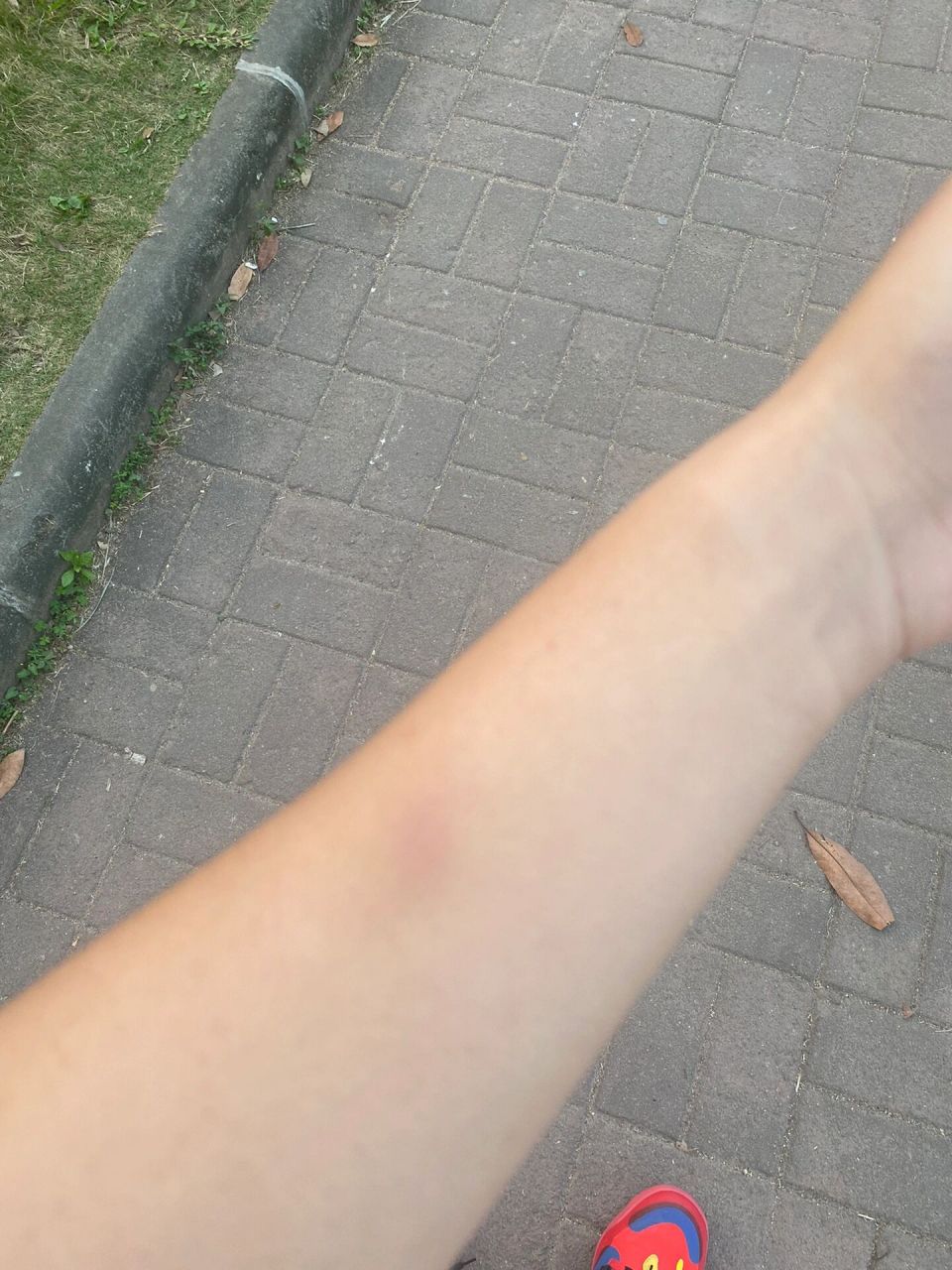 手臂黑了一块是怎么个事儿 来个懂的帮我诊断一下😭😭起步癌症吗