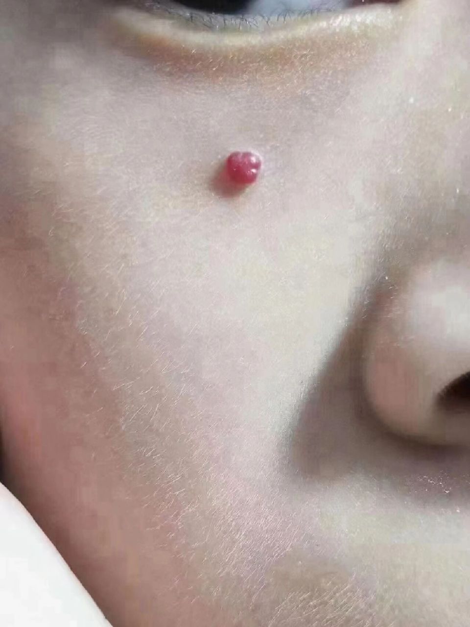 红痣～因红而得名,最是‬常见的良性瘤肿‬,是由于人皮体‬肤
