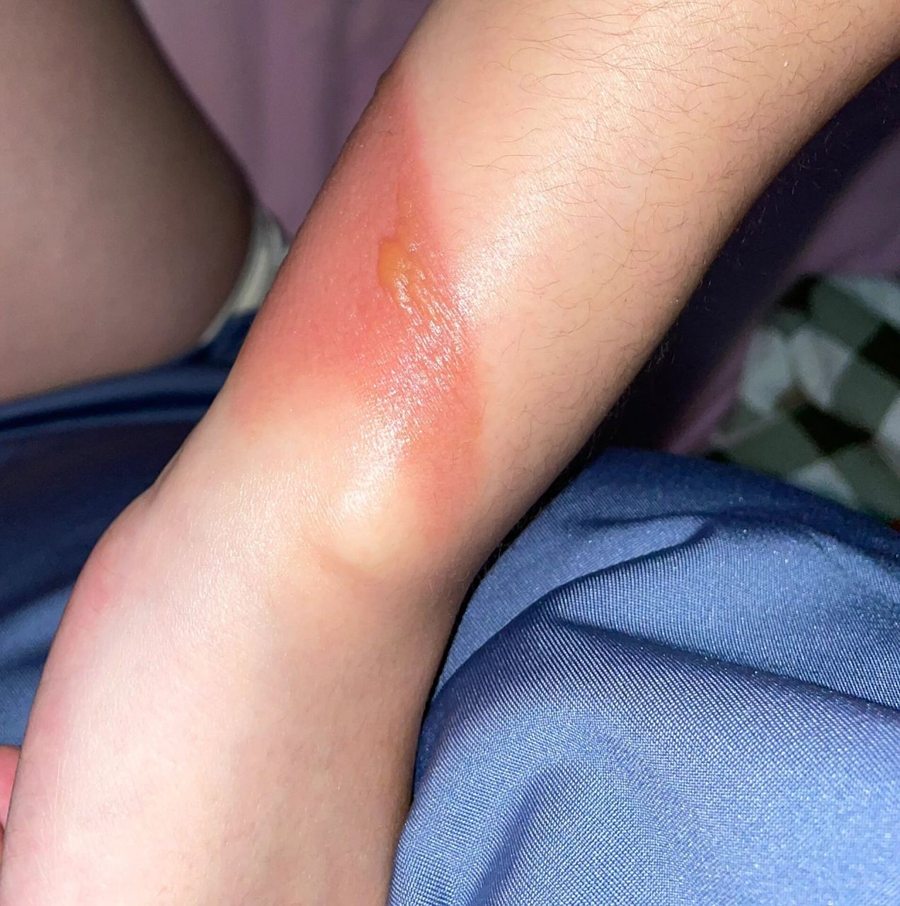 怀孕37周被蒸汽烫伤的处理方法.