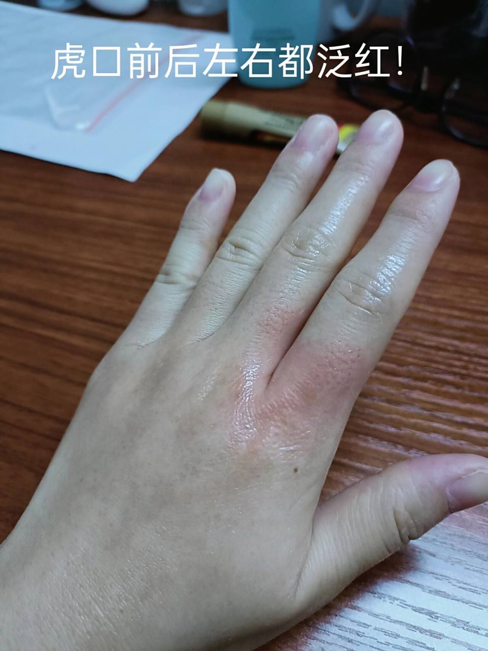 又水逆了昨晚被开水及水蒸气烫伤近三分之一的手背和两根手指,那个