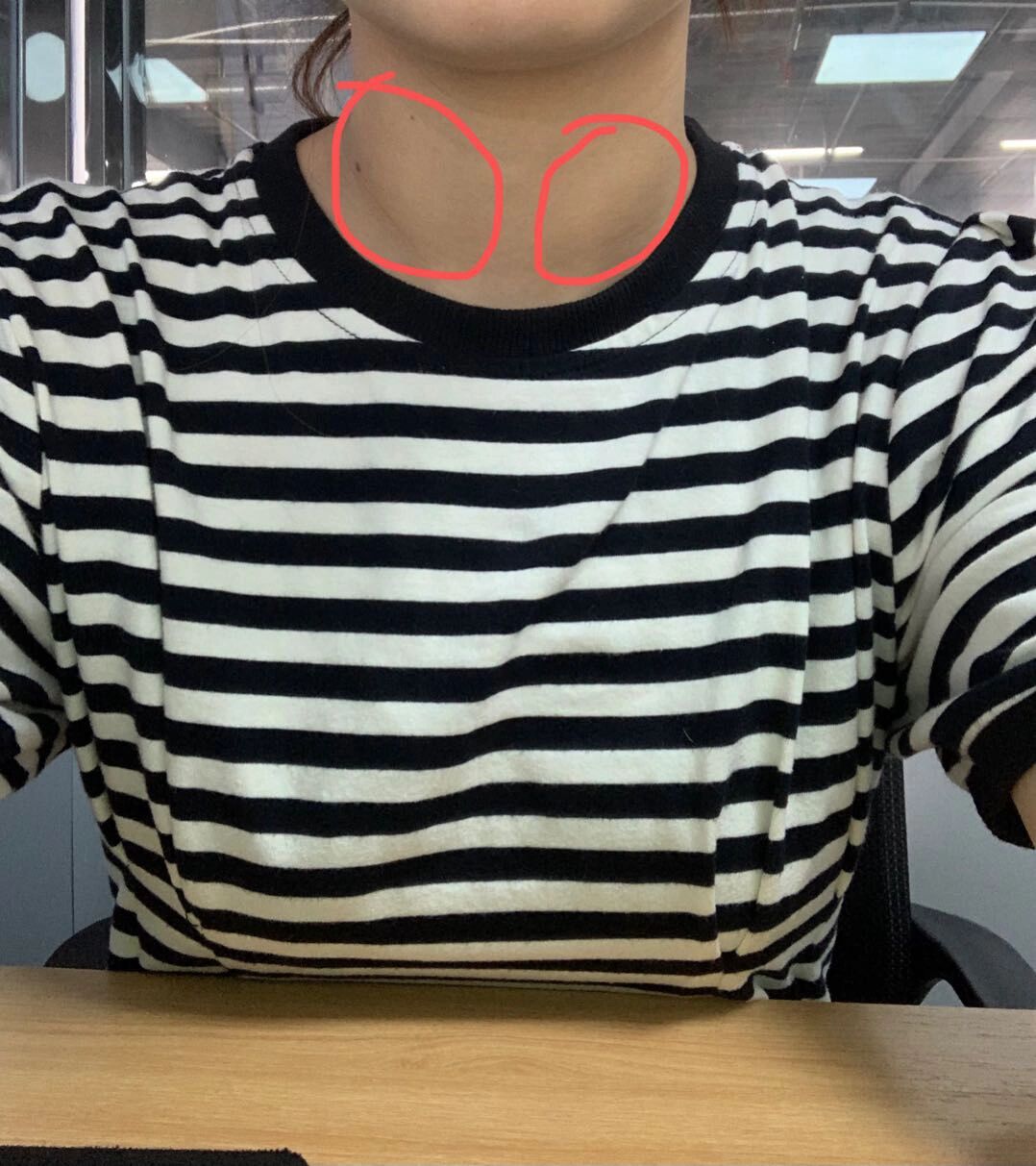 同事说我脖子很粗,问我是不是有甲状腺问题