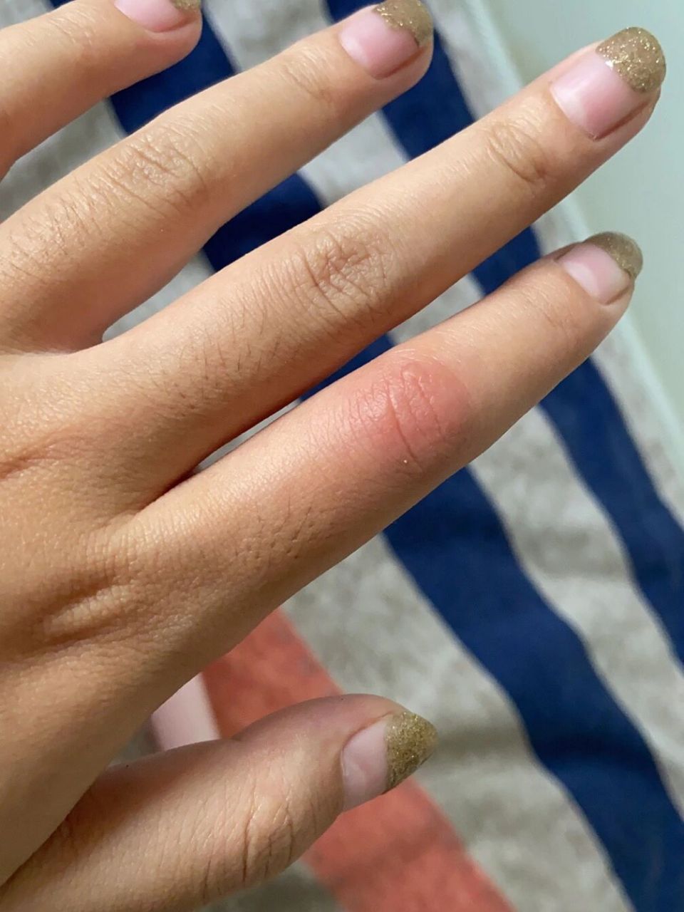手指关节处突然肿痒 从昨晚睡觉前就开始了,以为是蚊虫叮咬,心想着过