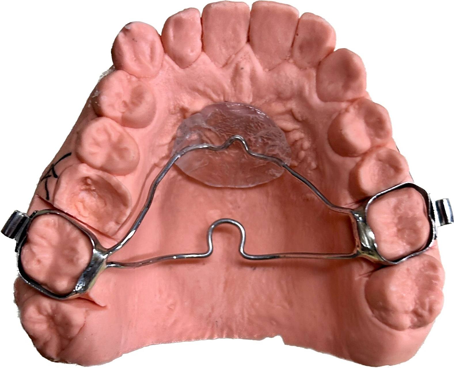 横腭杆tpa nance 兰丝弓 横腭杆 兰丝弓 横腭杆 兰丝弓在正畸治疗中