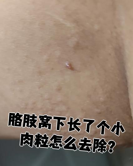 胳肢窝下长了个小肉粒怎么去除?
