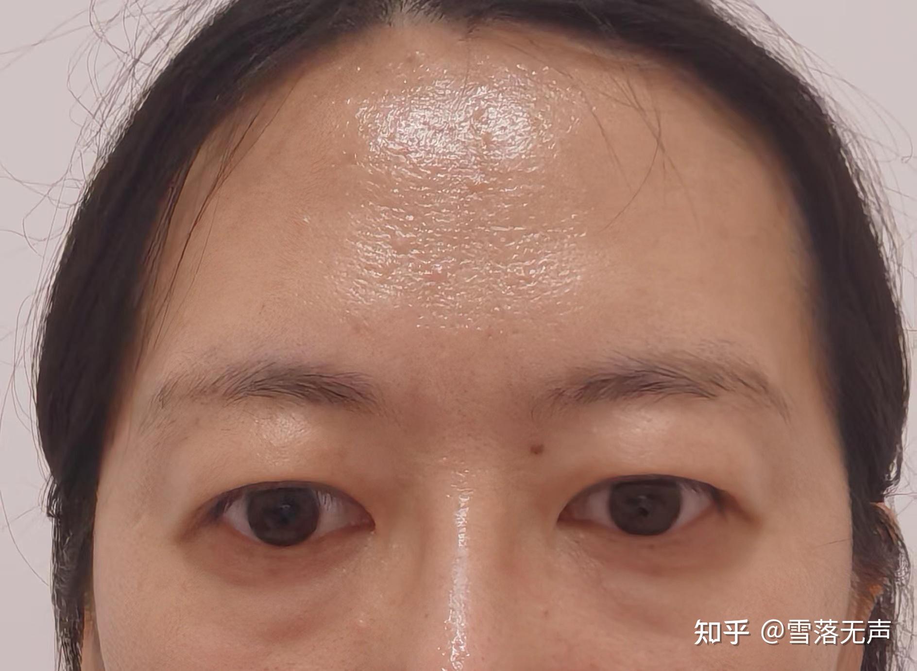 一次性做完双眼皮提眉内切眼袋的感受