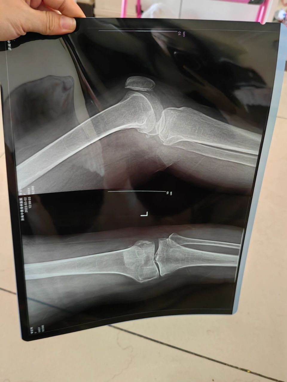 我妈膝盖疼的太严重,今天终于肯去检查,临时着急去了济南中德骨科