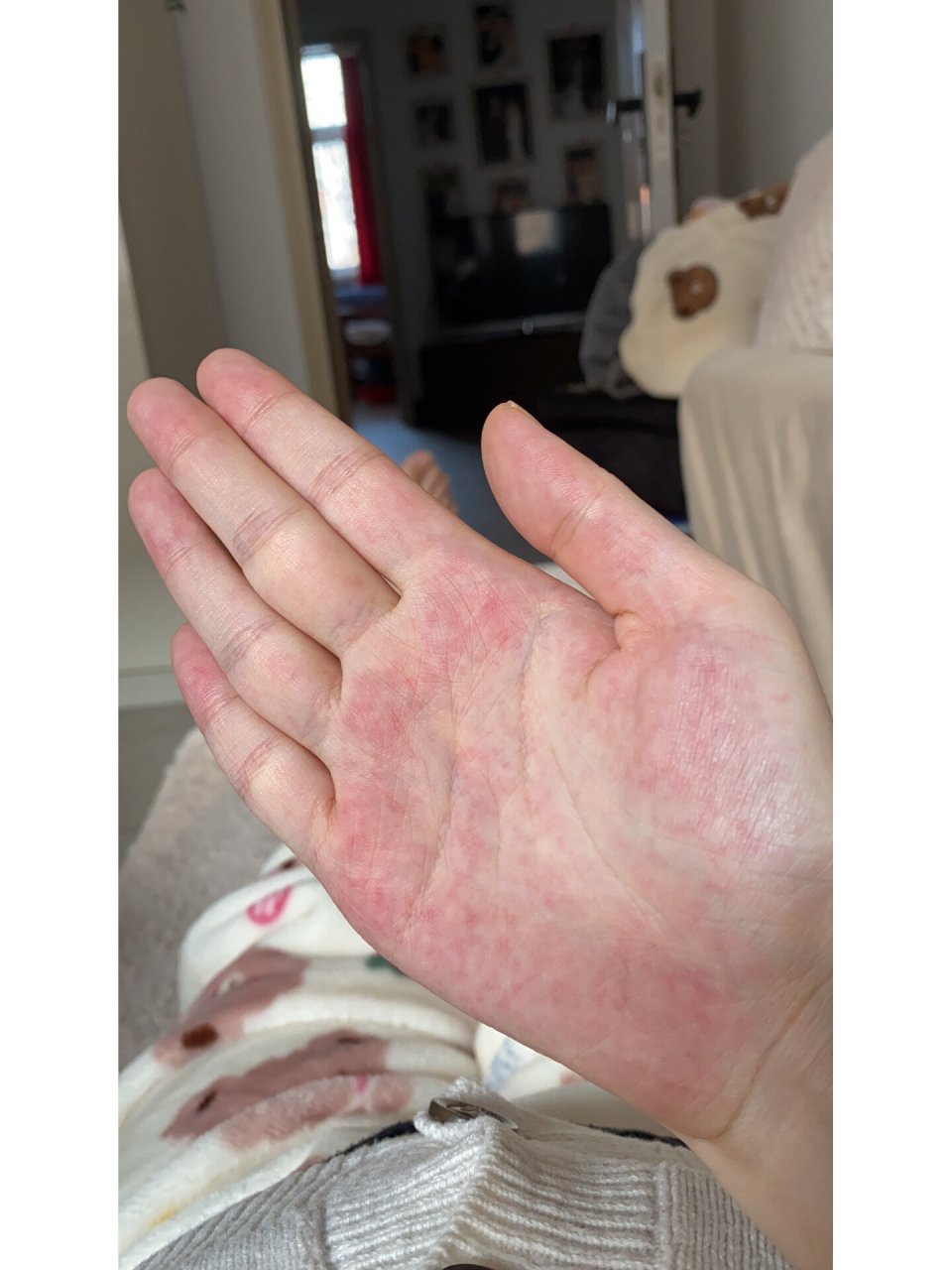 大家怀孕有手掌变这样的吗 孕33w➕5 昨天偶然发现手心都是红色印子