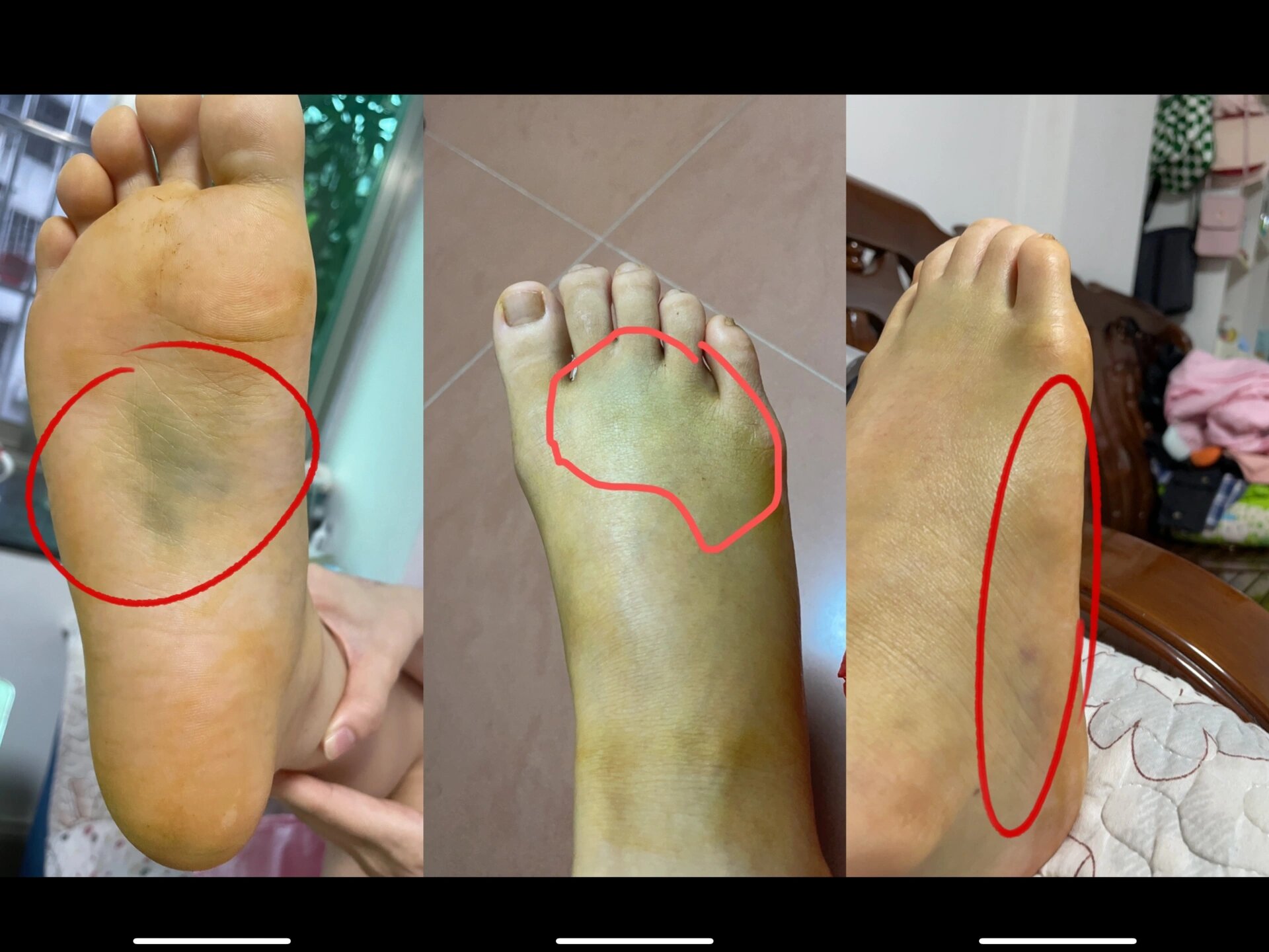 脚底和脚背的淤血也更明显了,医生说