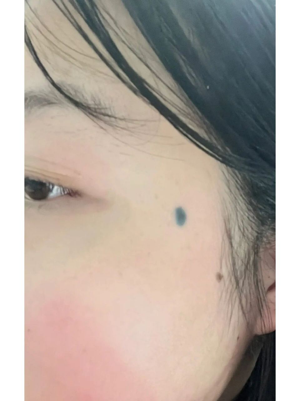 在太阳穴附近,也磨擦不到,有点青蓝色,需不需要弄去,去医院还是去店