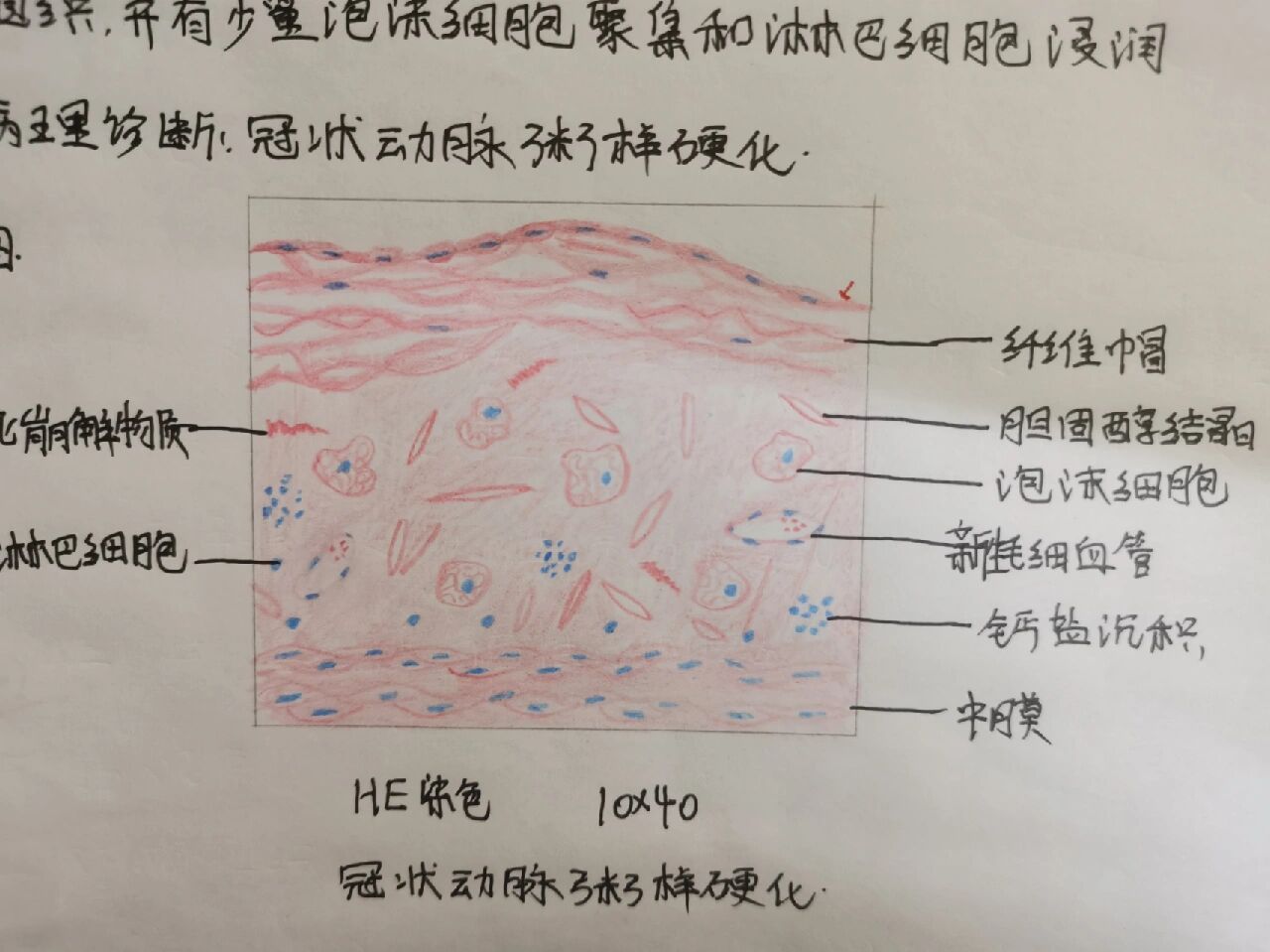 动脉粥样硬化红蓝铅笔图片