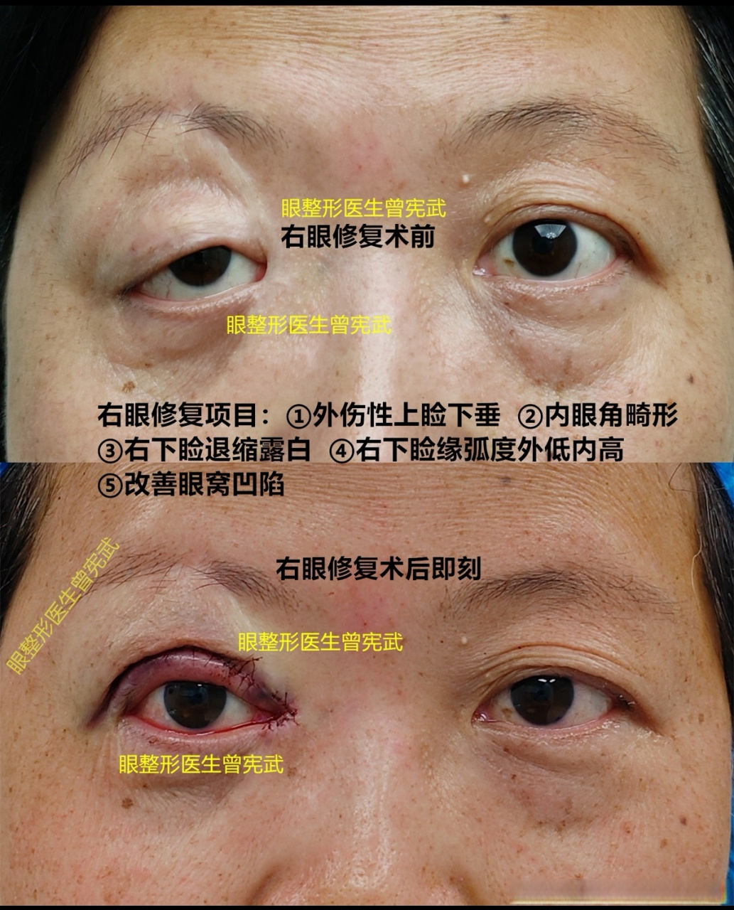 上睑下垂矫正#患者两年前不慎摔伤右眼,当时到三甲医院做了缝合,伤后