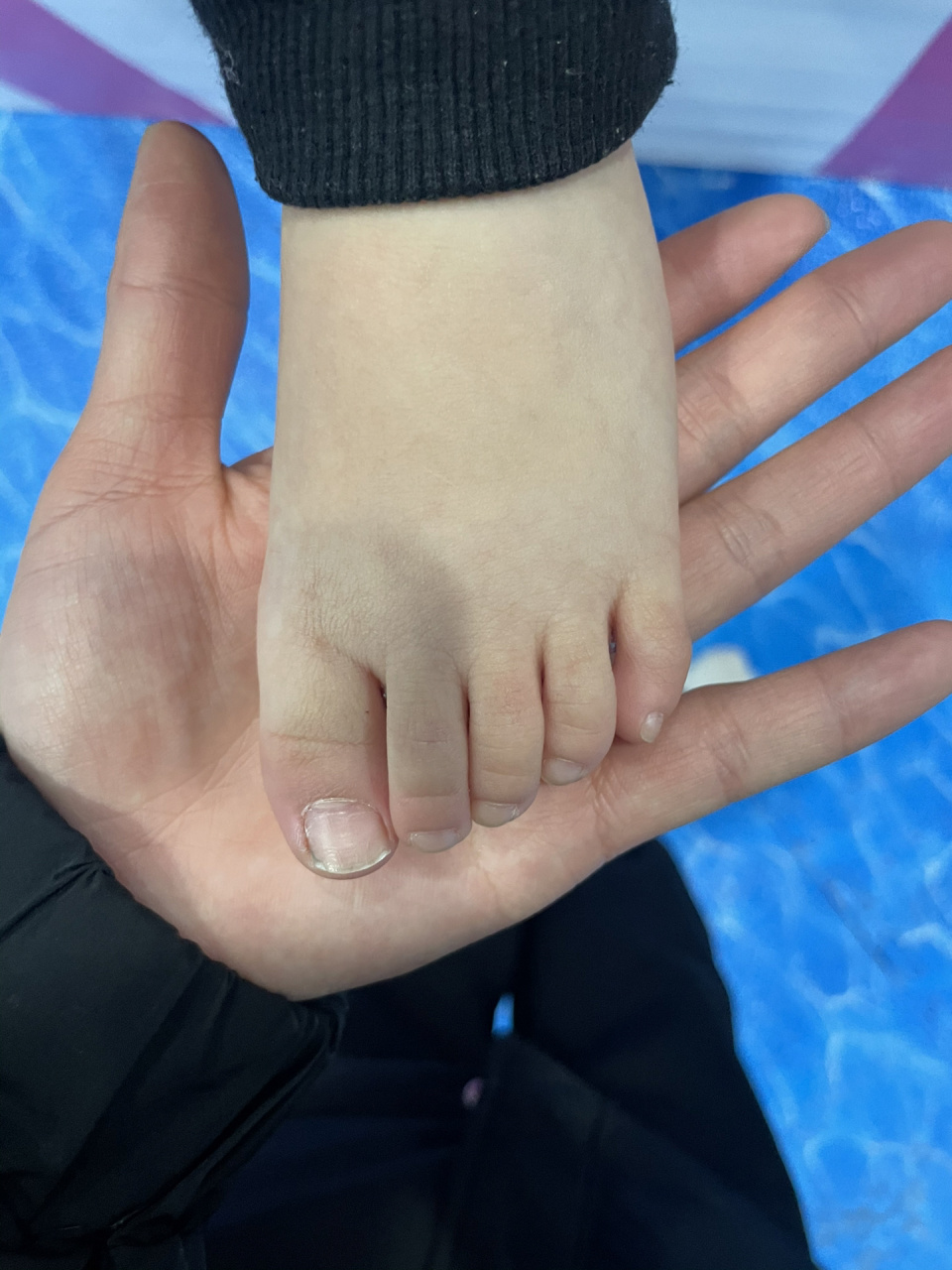 宝宝9299脚指歪了 突然发现我家宝宝大脚趾往里歪了有没有专业